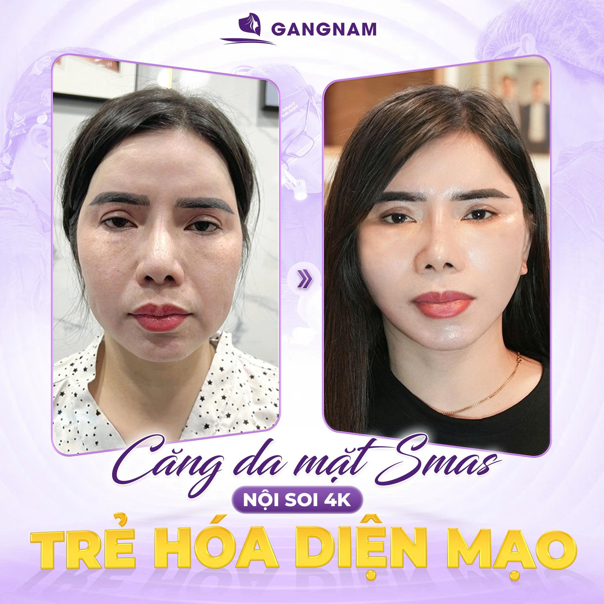 Căng Da Mặt SMAS Nội Soi: Giải Pháp Trẻ Hóa Tầng Sâu Hiện Đại, An Toàn 5 Đối tượng phù hợp thực hiện căng da mặt SMAS nội soi