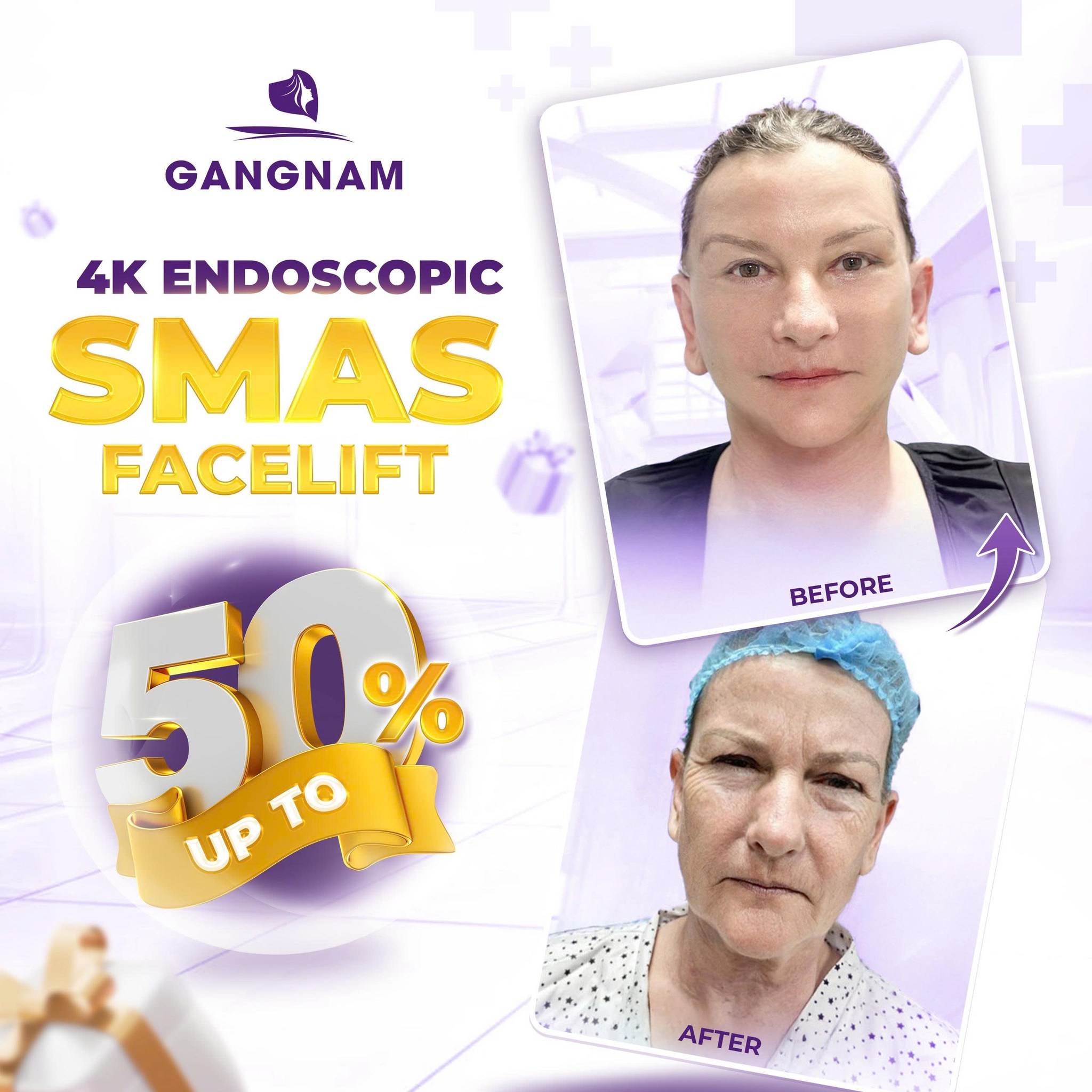 Căng Da Mặt SMAS Nội Soi: Giải Pháp Trẻ Hóa Tầng Sâu Hiện Đại, An Toàn 6 Căng da mặt SMAS nội soi tại Thẩm mỹ Gangnam – Giải pháp trẻ hóa tầng sâu hiện đại