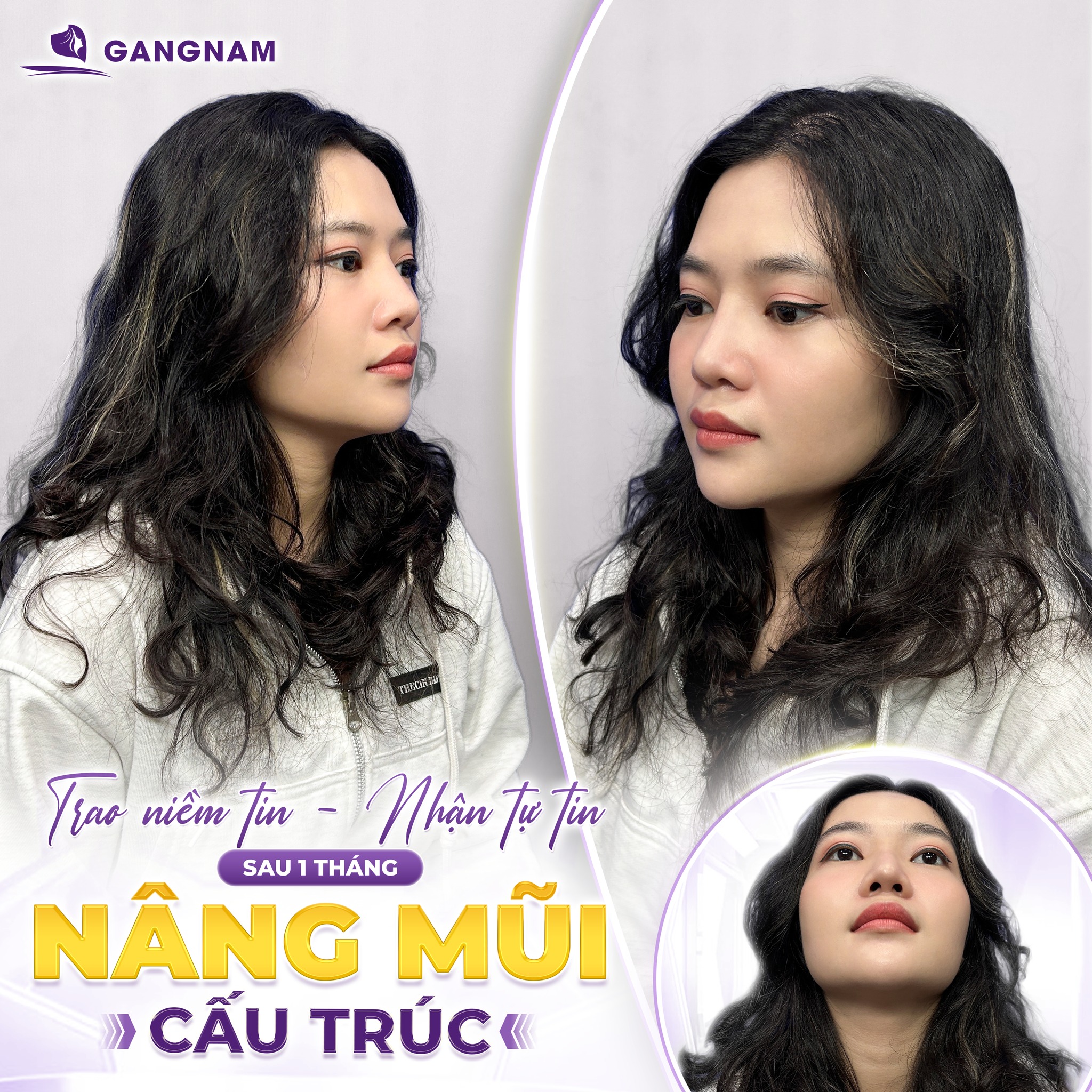 Công Nghệ Nâng Mũi Cấu Trúc Không Đau – Ít Xâm Lấn, Hồi Phục Nhanh 5 Giai đoạn hậu phẫu sau nâng mũi cấu trúc không đau