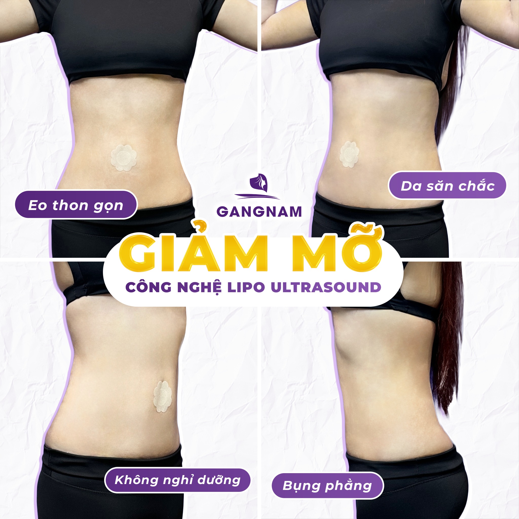 Hút Mỡ Eo Nội Soi: Giải Pháp Tạo Vòng 2 Thon Gọn, Ít Xâm Lấn 5 Quy trình thực hiện hút mỡ eo nội soi chi tiết