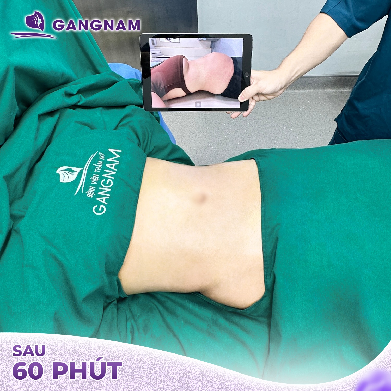 Hút Mỡ Vòng Eo Lipo Ultrasound – Giải Pháp Eo Thon Nhanh Chóng An Toàn 4 Hút mỡ vòng eo Lipo Ultrasound là gì