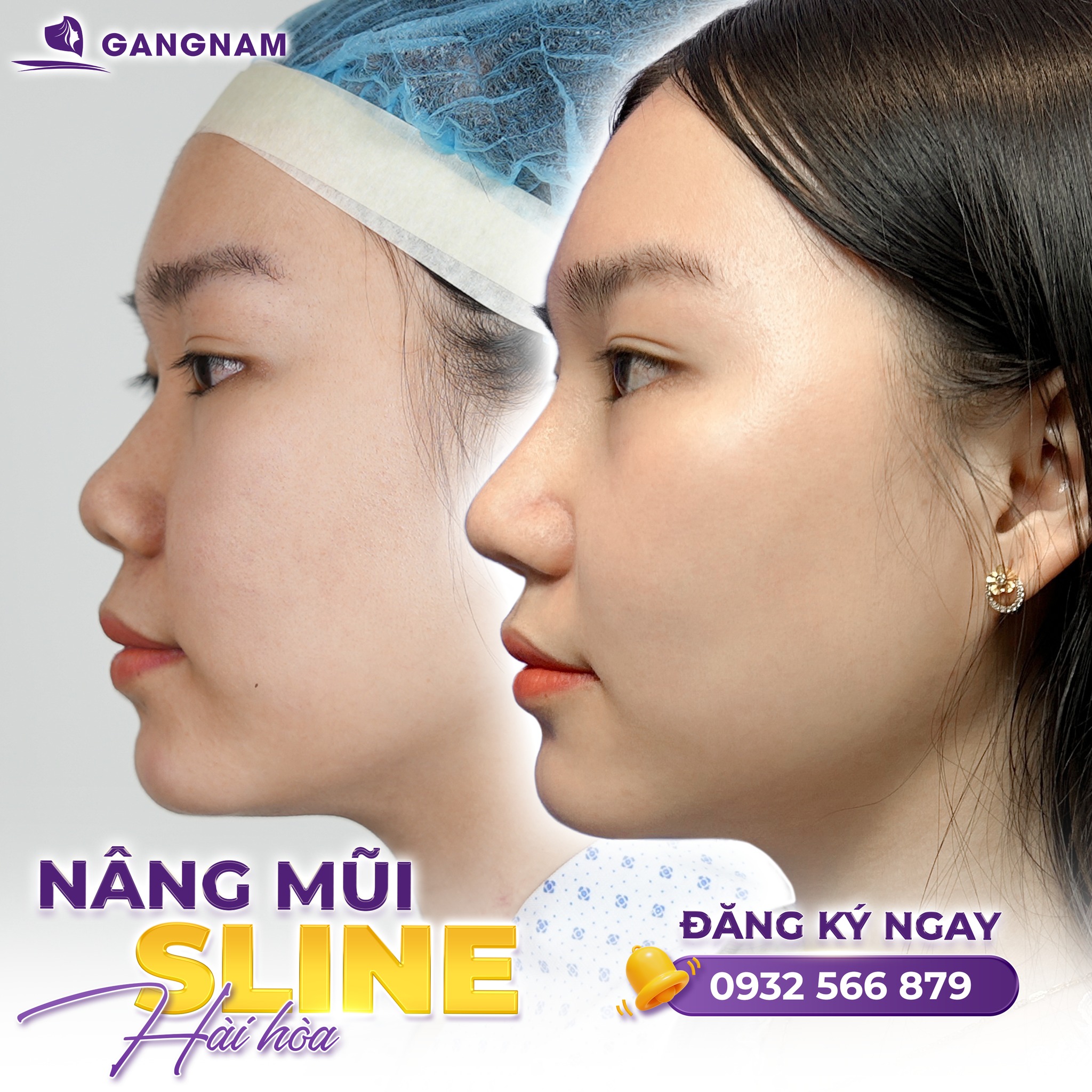 Nâng mũi S line hiện đại: Giải pháp kiến tạo đường cong thanh tú cho khuôn mặt 4 Phương pháp nâng mũi S line hiện đại là gì?