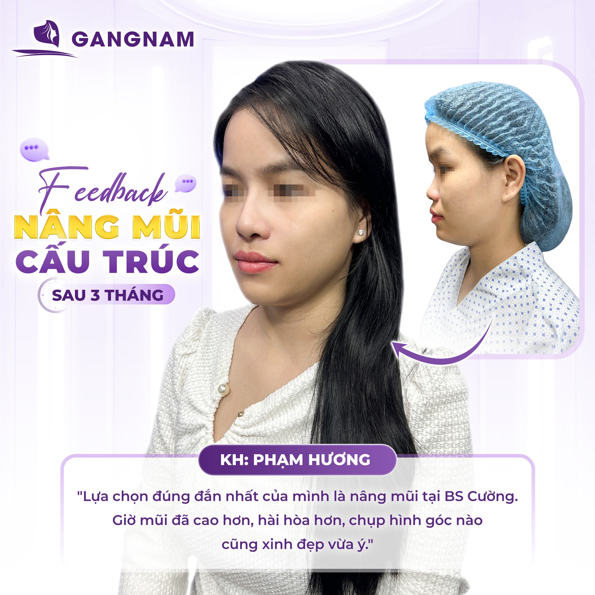 Công Nghệ Nâng Mũi Cấu Trúc Không Đau – Ít Xâm Lấn, Hồi Phục Nhanh 4 Nâng mũi cấu trúc không đau là gì
