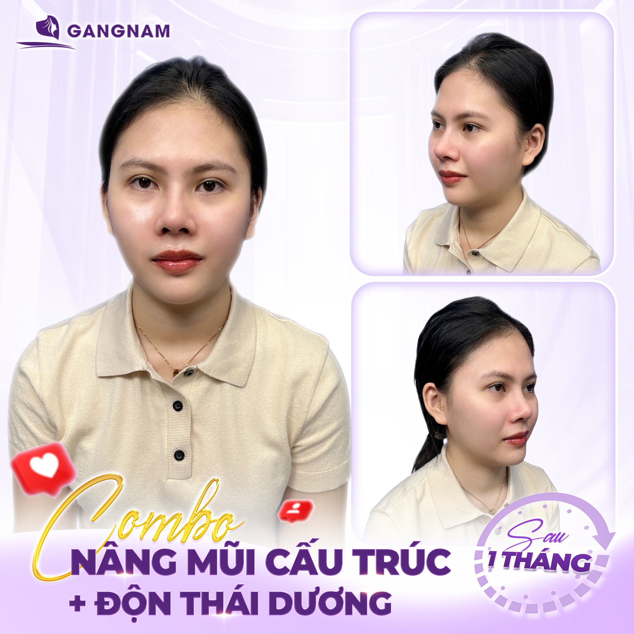 Công Nghệ Nâng Mũi Cấu Trúc Không Đau – Ít Xâm Lấn, Hồi Phục Nhanh 6 Nâng mũi cấu trúc không đau tại Thẩm mỹ Gangnam