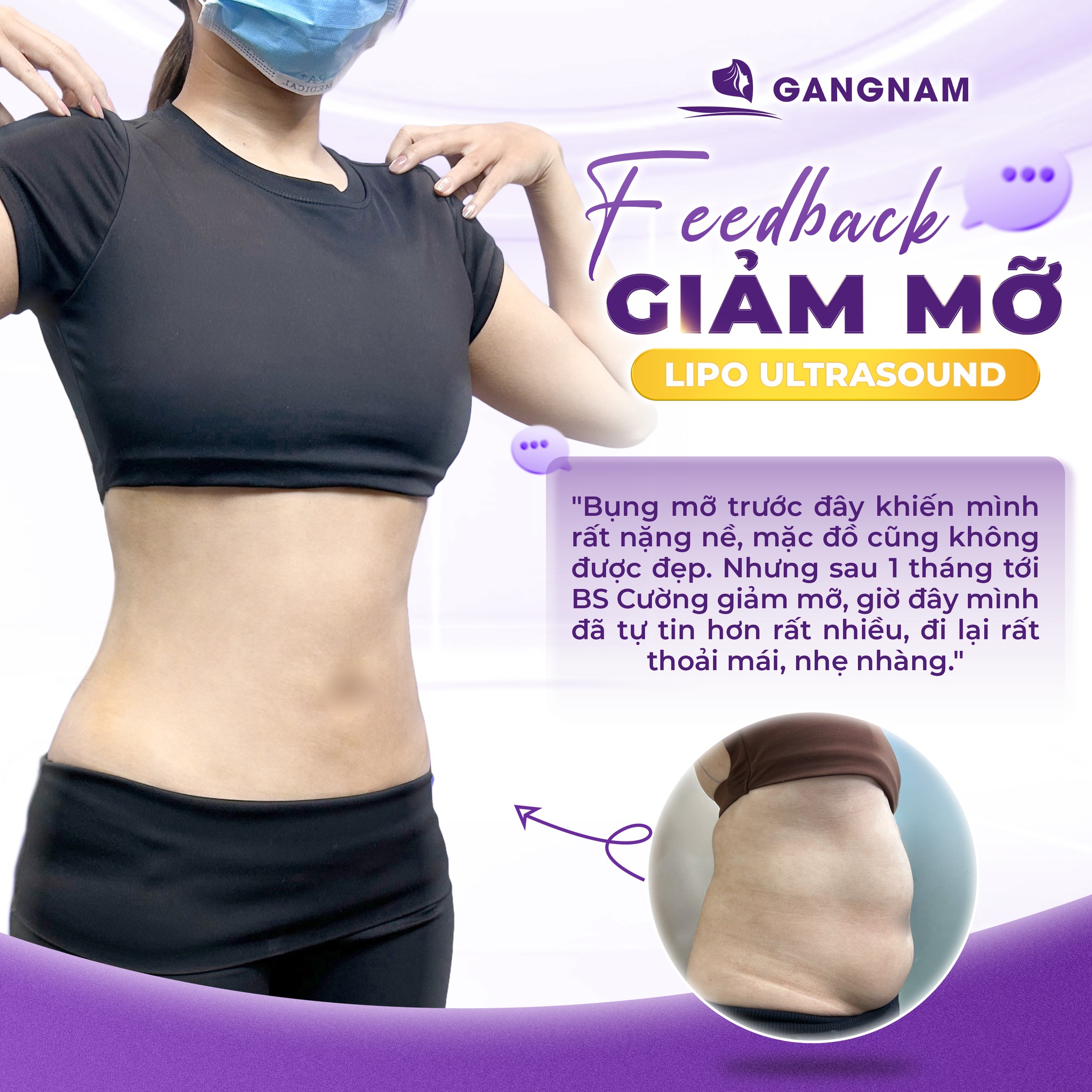 Hút Mỡ Eo Công Nghệ Lipo: Giải Pháp Tạo Dáng Thon Gọn An Toàn 4 Hút mỡ eo công nghệ Lipo là gì