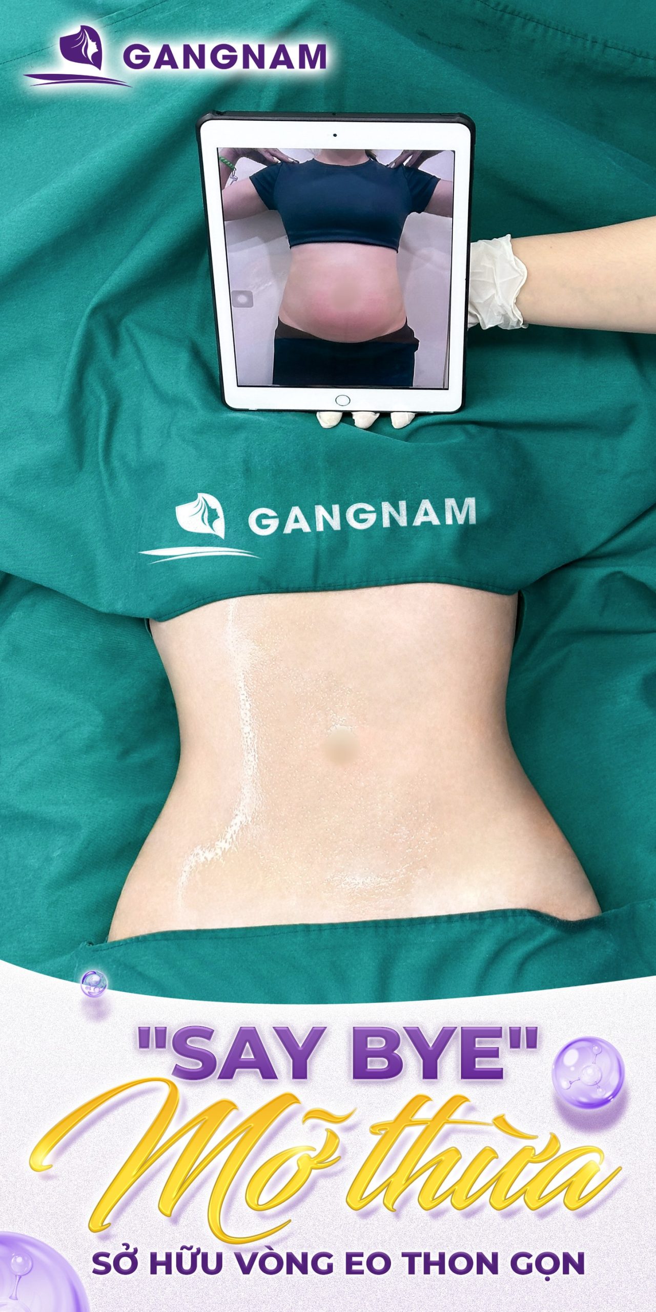 Hút Mỡ Eo Công Nghệ Lipo: Giải Pháp Tạo Dáng Thon Gọn An Toàn 6 Hút mỡ eo công nghệ Lipo tại Thẩm mỹ Gangnam