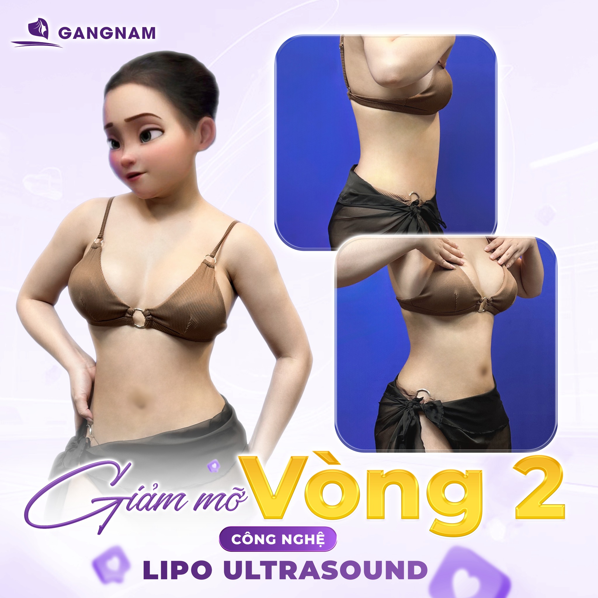Hút Mỡ Hông Công Nghệ Lipo Ultrasound –Tạo Đường Cong Eo Hông Săn Chắc 4 Hút mỡ hông công nghệ Lipo là gì