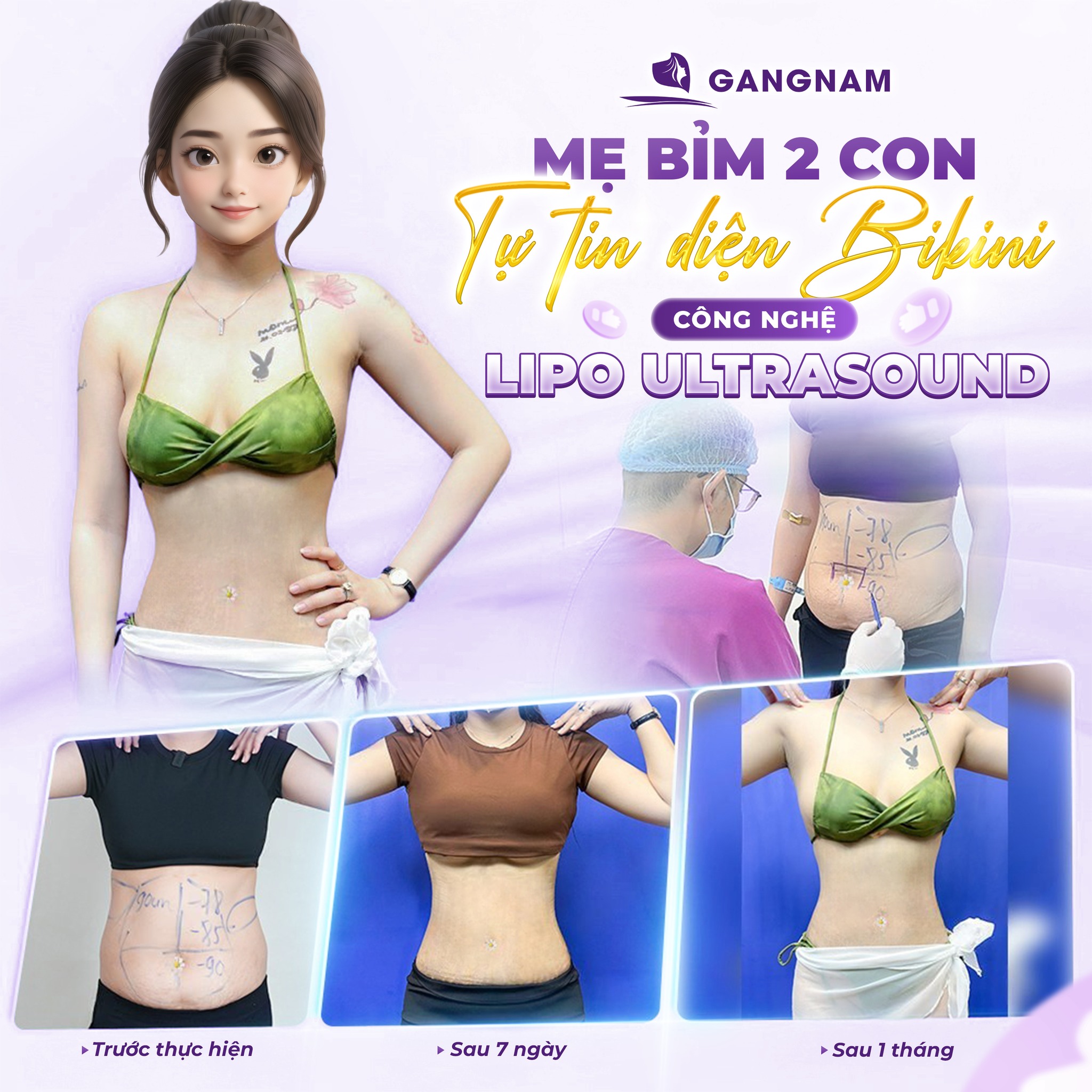 Giảm Mỡ Vòng 2 Lipo Thon Gọn: Giải Pháp Hiện Đại Cho Vòng Eo Săn Chắc 5 Công nghệ hiện đại trong giảm mỡ vòng 2 Lipo thon gọn
