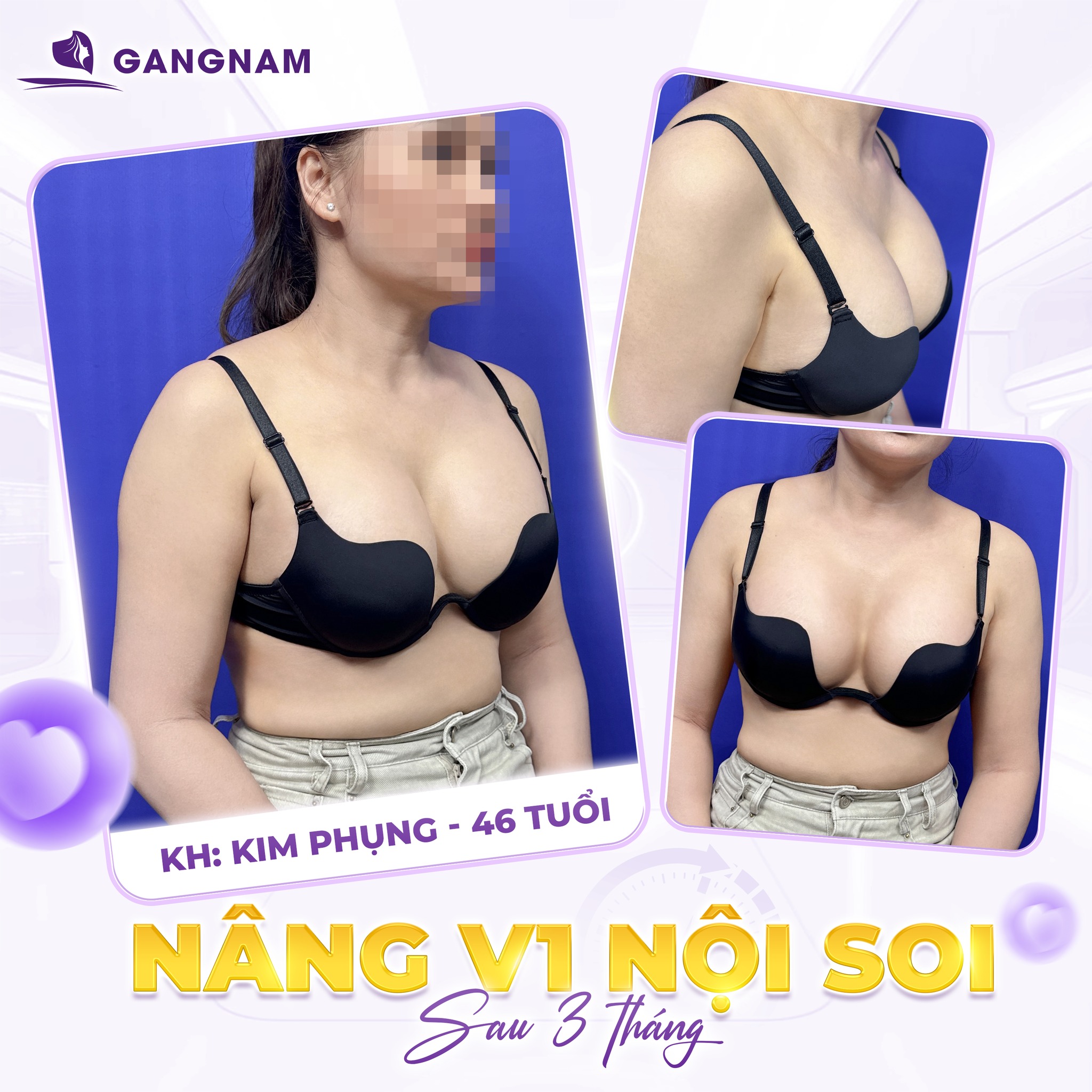 Nâng Ngực Công Nghệ Nội Soi: Giải Pháp An Toàn Cho Vòng Một Tự Nhiên 4 Nâng ngực công nghệ nội soi là gì