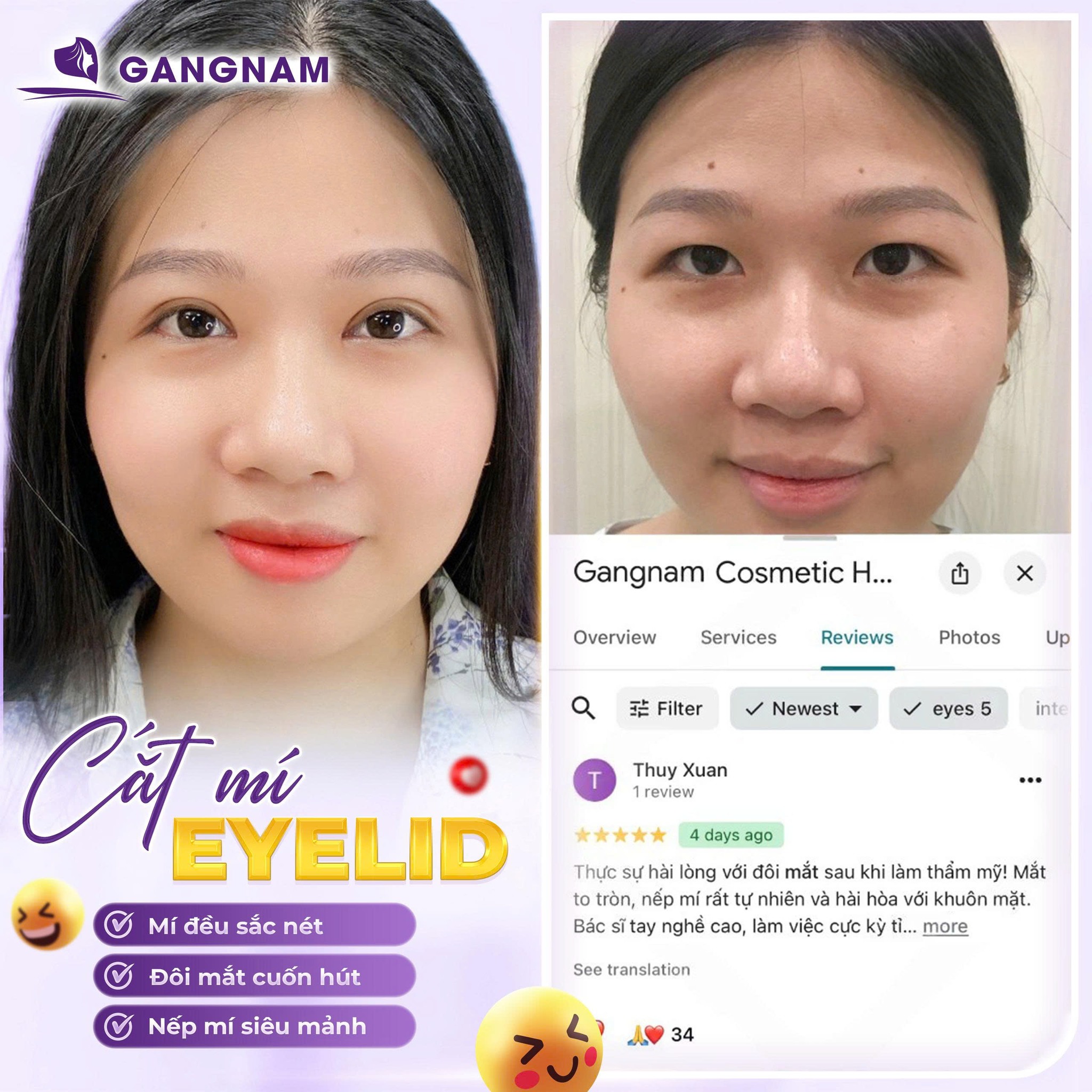 Cải Thiện Mắt Một Mí Giải Pháp Sở Hữu Đôi Mắt Hai Mí Tự Nhiên 5 Cải Thiện Mắt Một Mí Giải Pháp Sở Hữu Đôi Mắt Hai Mí Tự Nhiên 2