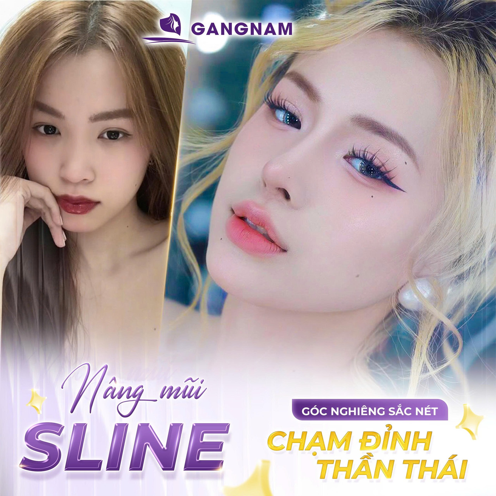 Nâng mũi nội soi hiện đại – Xu hướng thẩm mỹ mũi an toàn, bền vững hiện nay 6 Nâng mũi nội soi hiện đại tại Thẩm mỹ Gangnam