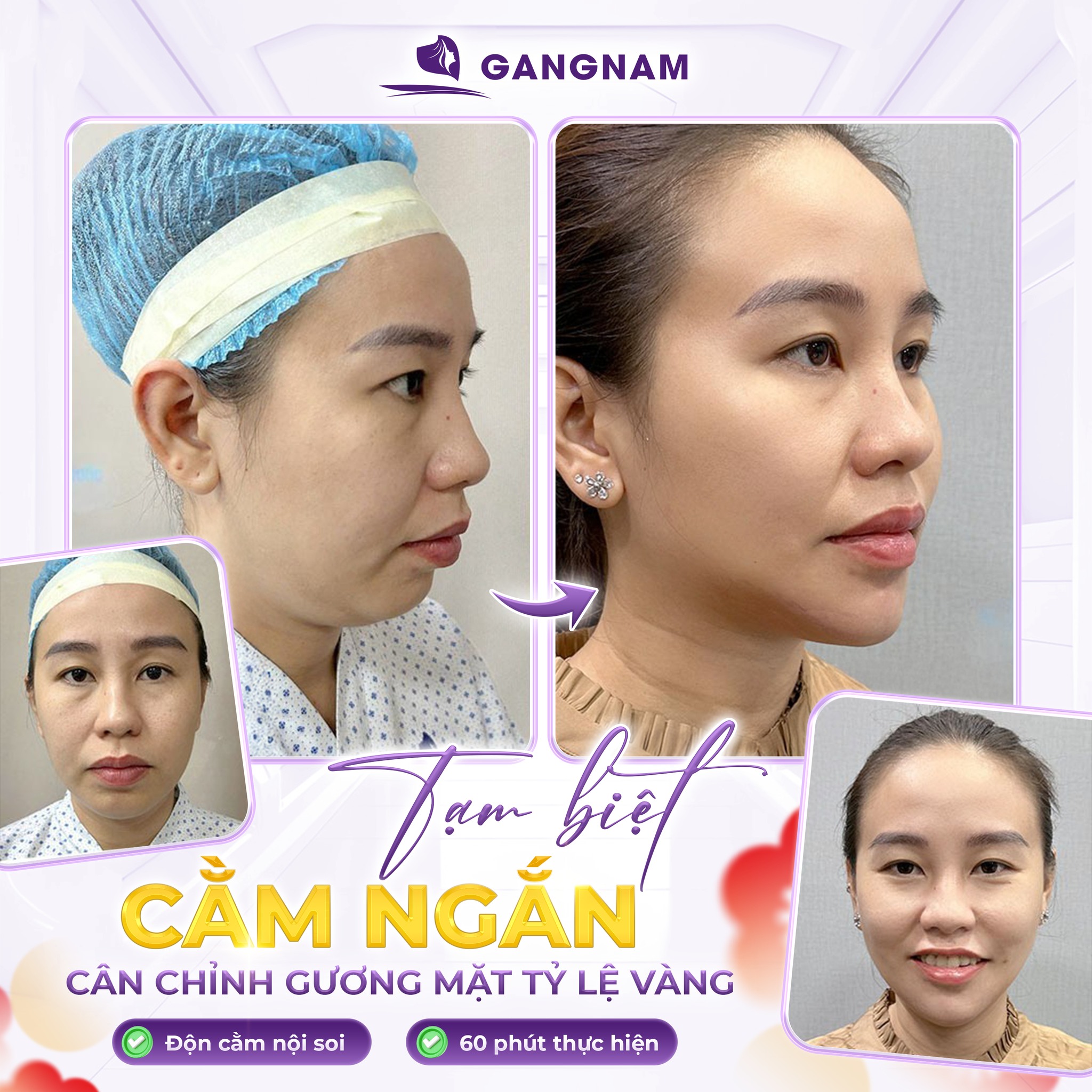 Phẫu Thuật Độn Cằm Là Gì? Quy Trình, Hồi Phục Và Lưu Ý Quan Trọng 6 Phẫu thuật độn cằm tại Thẩm mỹ Gangnam – Giải pháp tạo dáng V-line hài hòa, tự nhiên