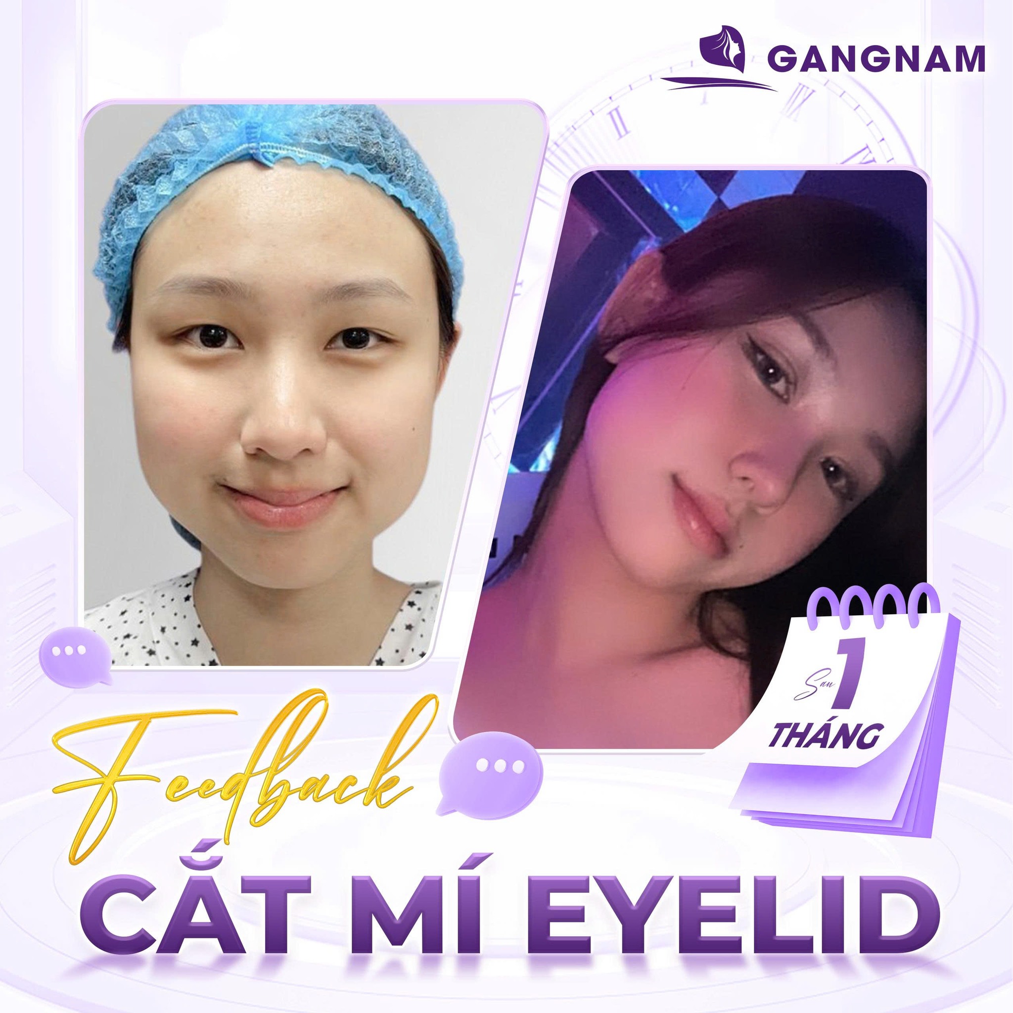 Cắt mí thẩm mỹ Eyelid: Giải pháp trẻ hóa đôi mắt an toàn, hiệu quả lâu dài 4 Cắt mí thẩm mỹ Eyelid là gì?