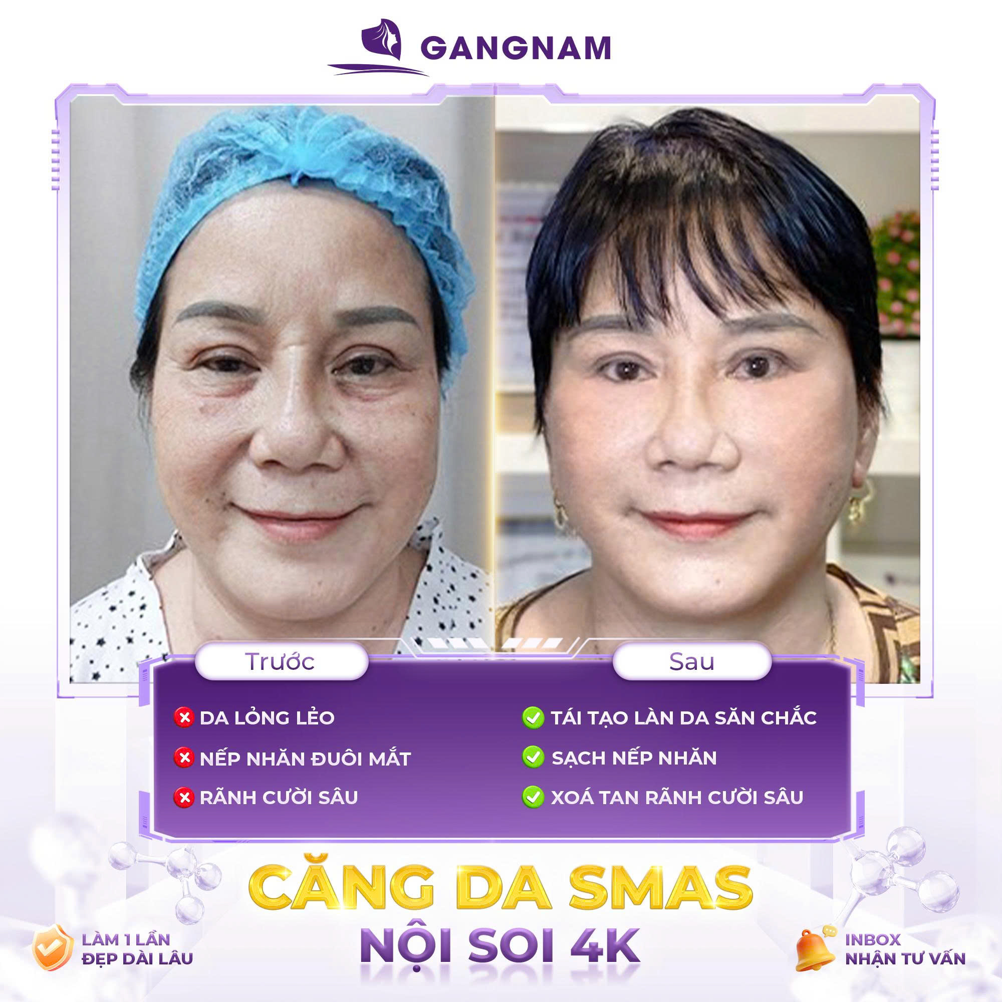 Căng Da Nội Soi SMAS: Bí Quyết Nâng Cơ Trẻ Hóa Tự Nhiên Không Lộ Dấu Vết 5 Đối tượng nào phù hợp thực hiện căng da nội soi SMAS?