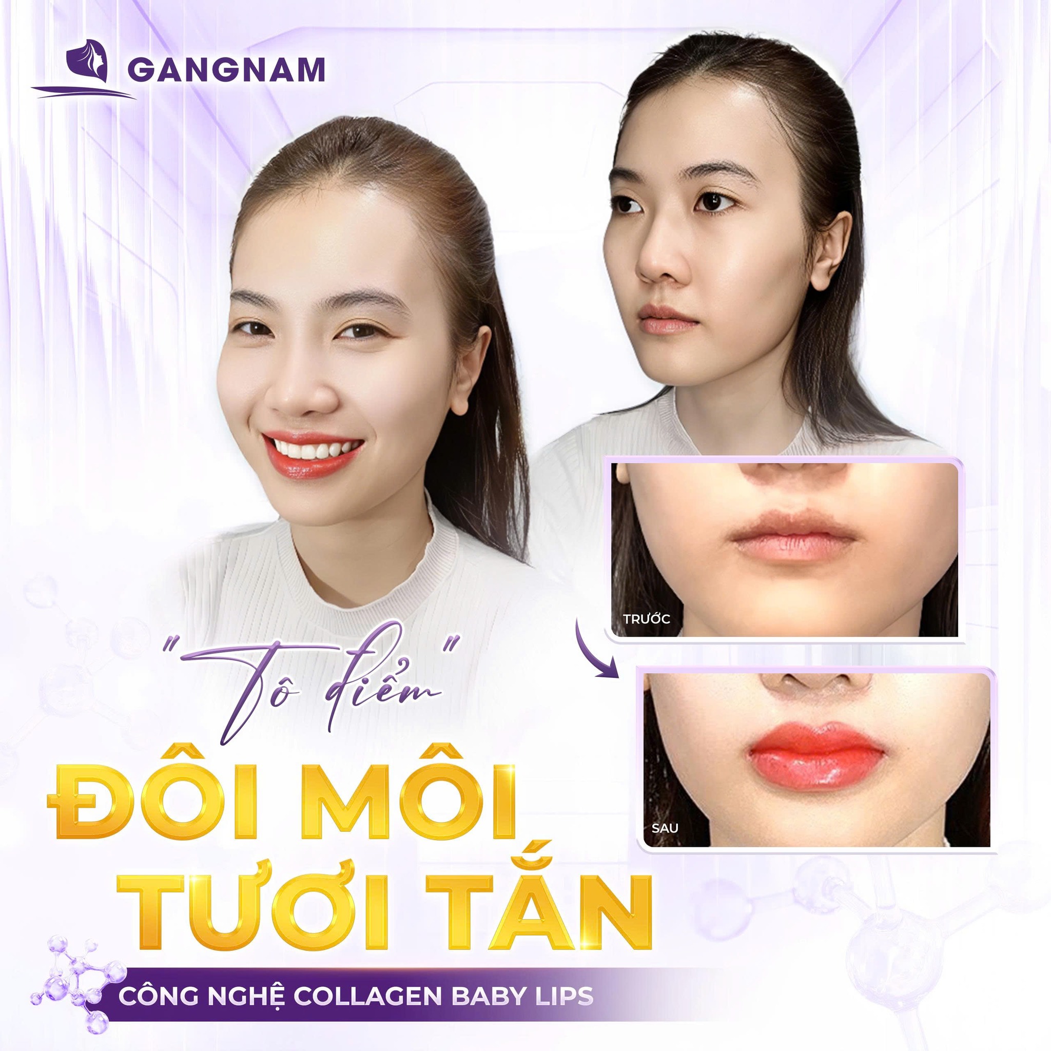 Tiêm Môi Thẩm Mỹ: Bí Quyết Sở Hữu Đôi Môi Căng Mọng, Tự Nhiên 6 Tiêm môi thẩm mỹ tại Thẩm mỹ Gangnam