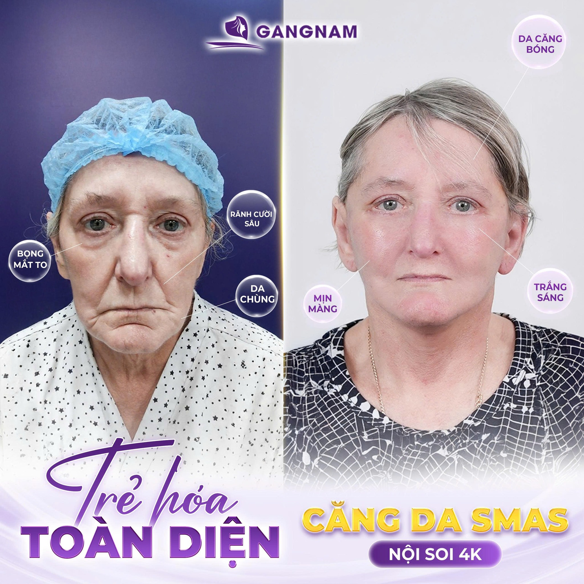 Căng da SMAS nội soi 4K: Giải pháp trẻ hóa tầng sâu giúp lưu giữ nét thanh xuân 6 Căng da SMAS nội soi 4K tại Thẩm mỹ Gangnam – Trẻ hóa an toàn, tự nhiên