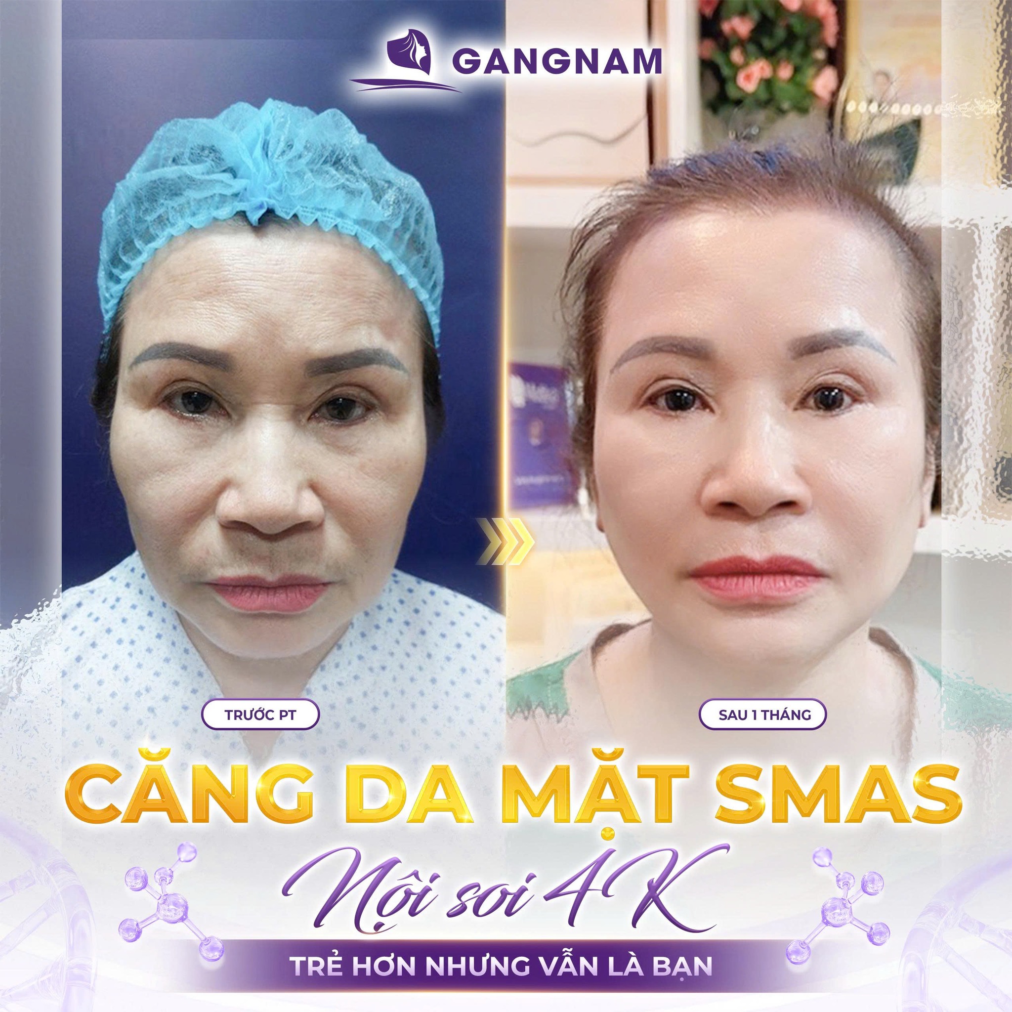 Căng Da Mặt SMAS Trẻ Hóa: Giải Pháp Trẻ Hóa Toàn Diện, Tự Nhiên 5 Căng Da Mặt SMAS Trẻ Hóa: Giải Pháp Trẻ Hóa Toàn Diện, Tự Nhiên 2