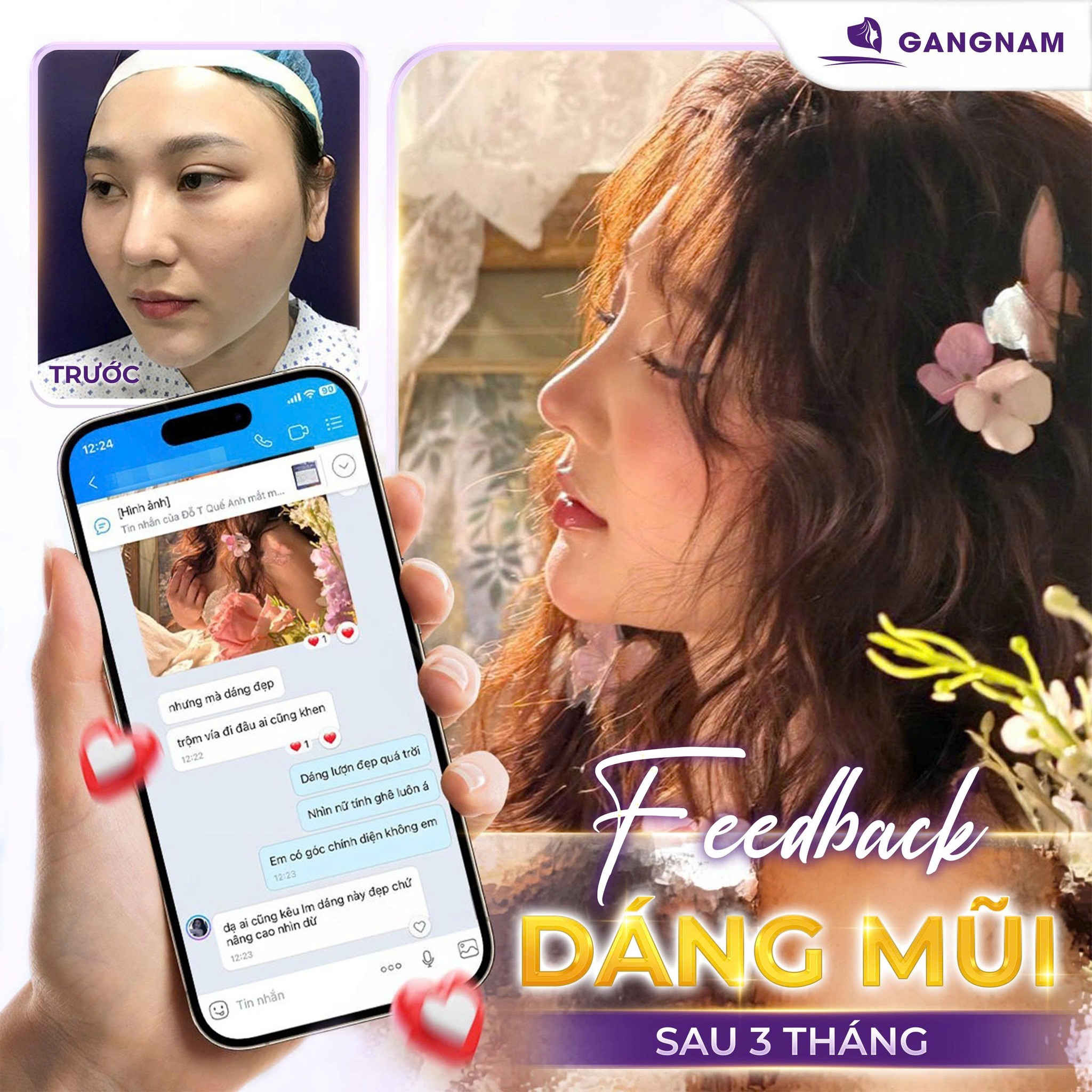 Nâng Mũi Sụn Nhân Tạo Là Gì? Ưu Điểm, Quy Trình Và Lưu Ý Quan Trọng 6 Nâng mũi sụn nhân tạo tại thẩm mỹ Gangnam