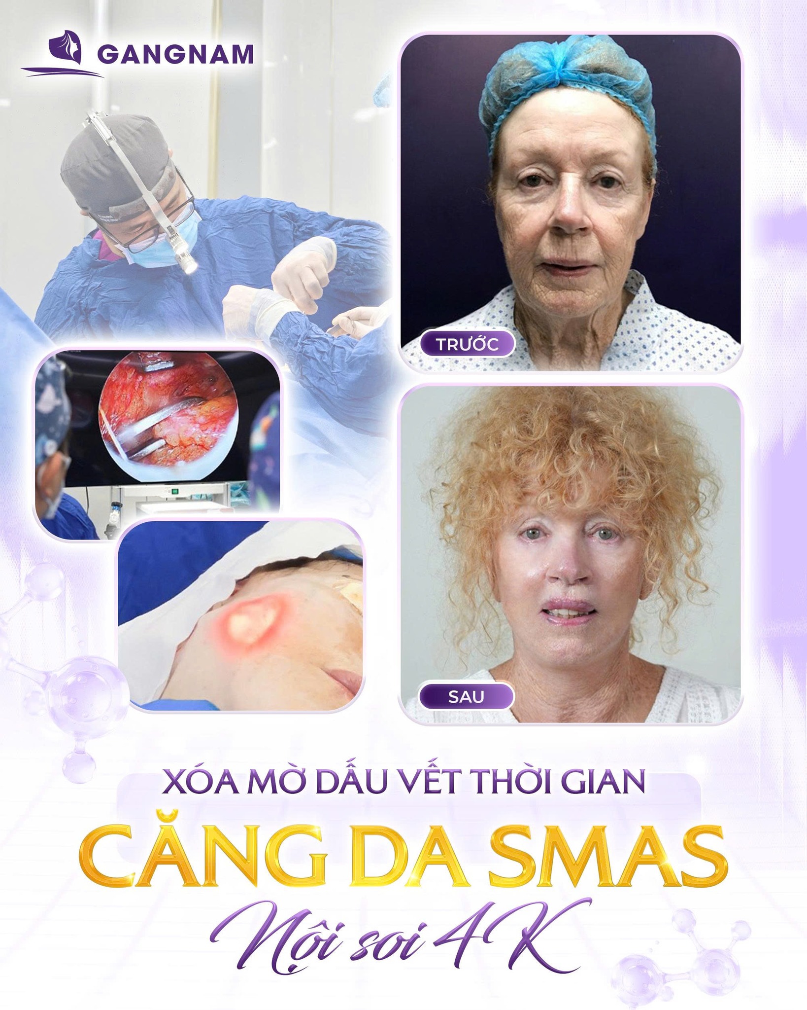 Nâng cơ mặt nội soi: Giải pháp trẻ hóa tự nhiên, ít xâm lấn và duy trì lâu dài 4 Nâng cơ mặt nội soi là gì?