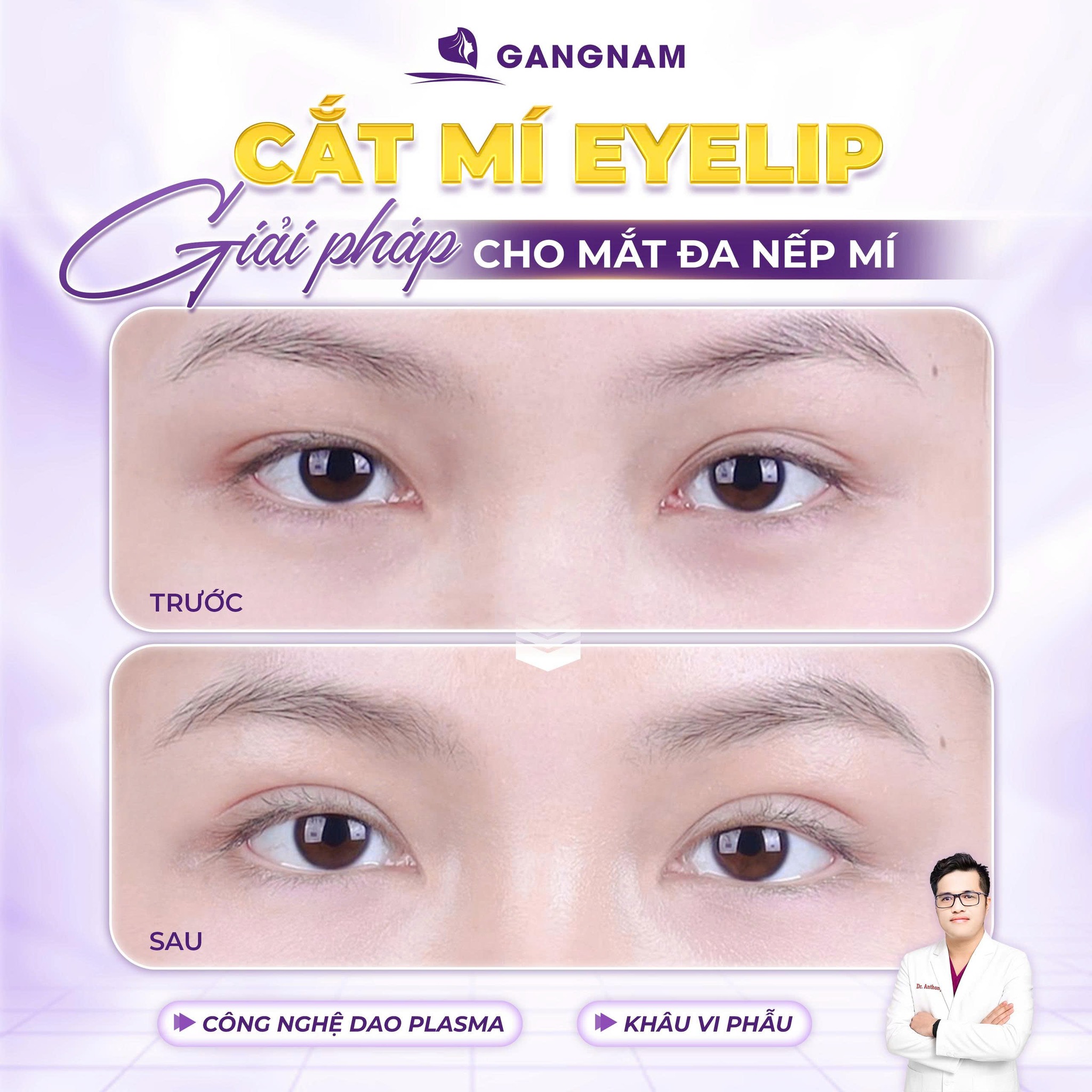 Cắt Mắt Eyelid Cùng Dr.Anthony Lê: Bí Quyết Sở Hữu Đôi Mắt To Tròn, Cuốn Hút 4 Cắt mắt Eyelid cùng Dr.Anthony Lê