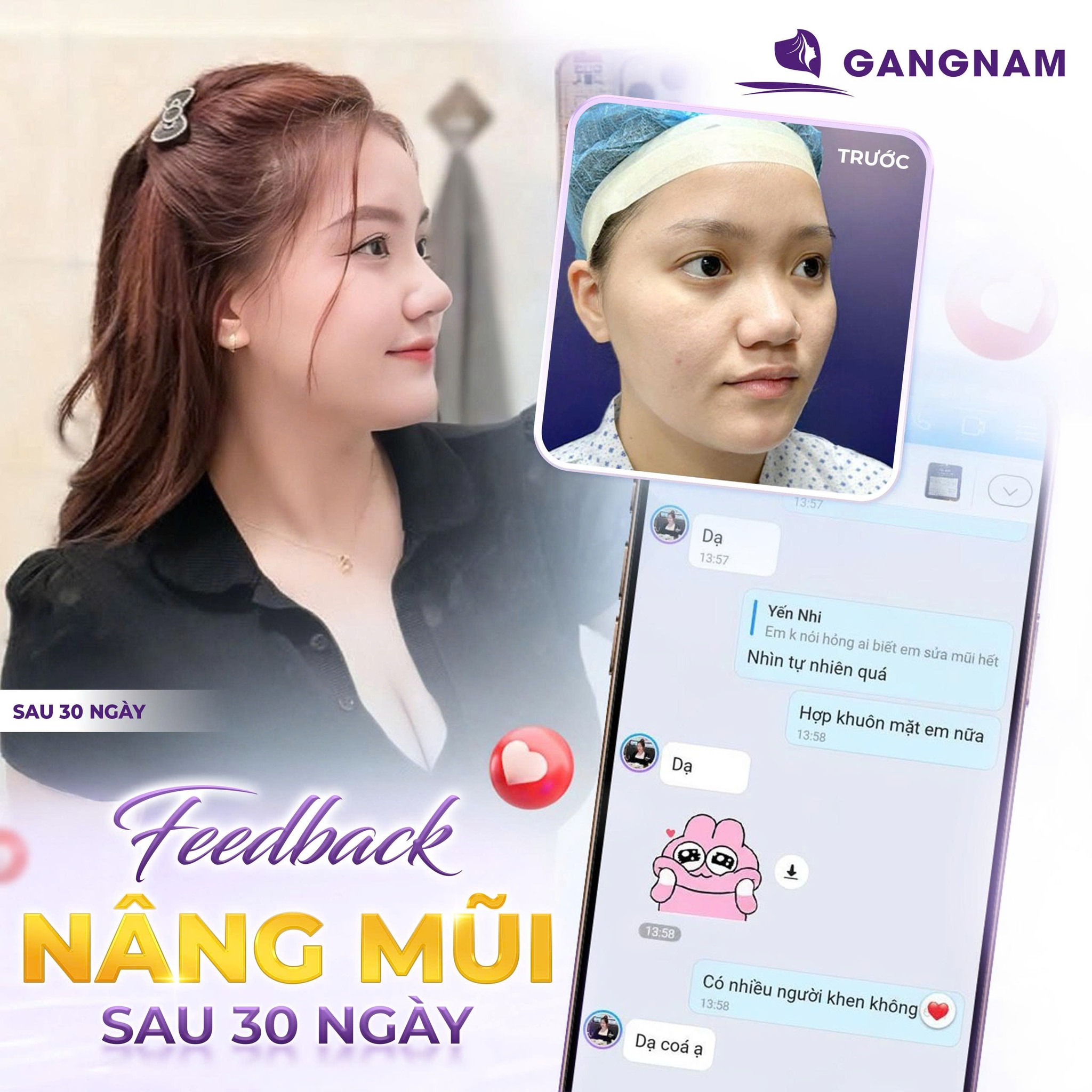 Nâng Mũi Sụn Nhân Tạo Là Gì? Ưu Điểm, Quy Trình Và Lưu Ý Quan Trọng 4 Nâng mũi sụn nhân tạo là gì