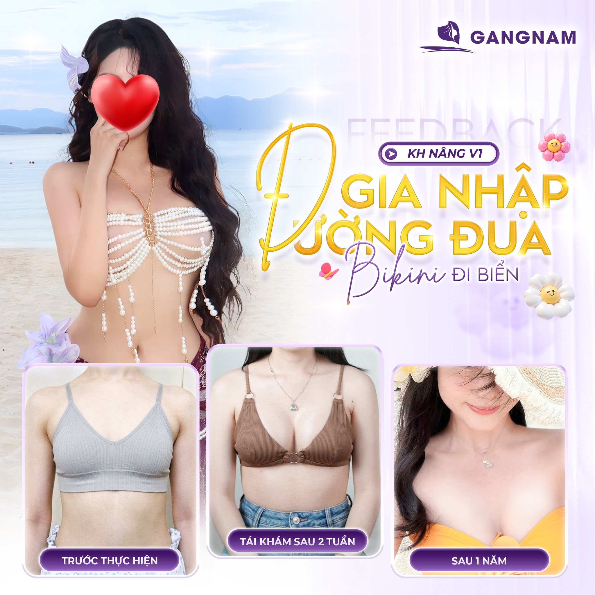 Nâng Ngực Nội Soi Chuẩn Form: Giải Pháp Tạo Dáng Vòng 1 Tự Nhiên 4 Nâng ngực nội soi chuẩn form là gì