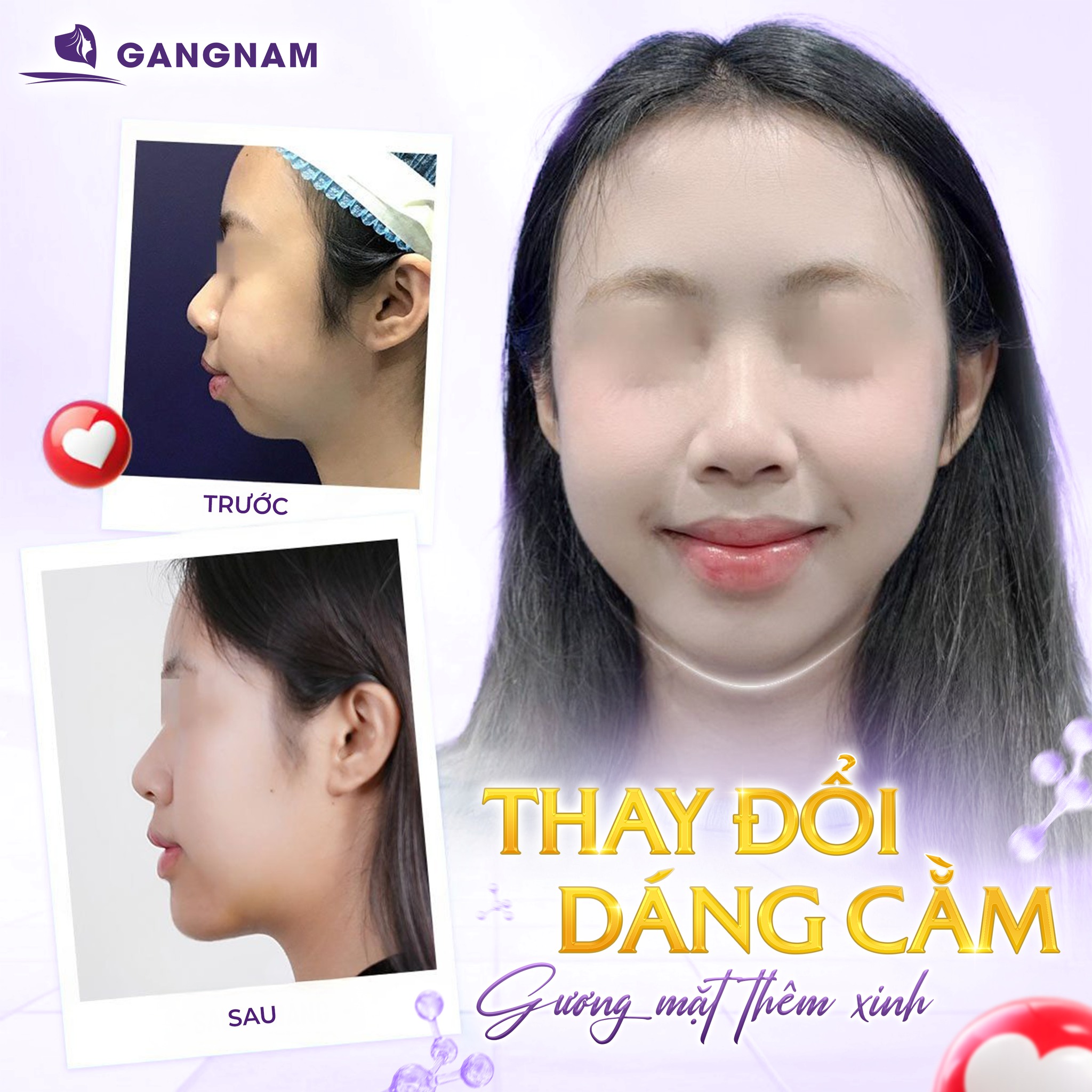 Độn Cằm Vline Thẩm Mỹ – Giải Pháp Tạo Dáng Cằm Chuẩn Tỷ Lệ Vàng 4 Độn cằm Vline thẩm mỹ là gì và các phương pháp thực hiện