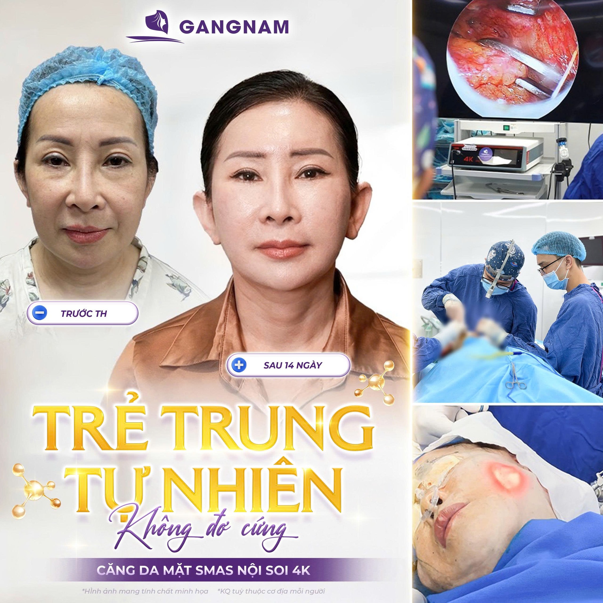 Phẫu Thuật Căng Da SMAS: Giải Pháp Trẻ Hóa Toàn Diện Duy Trì Lâu Dài 4 Phẫu thuật căng da SMAS là gì?