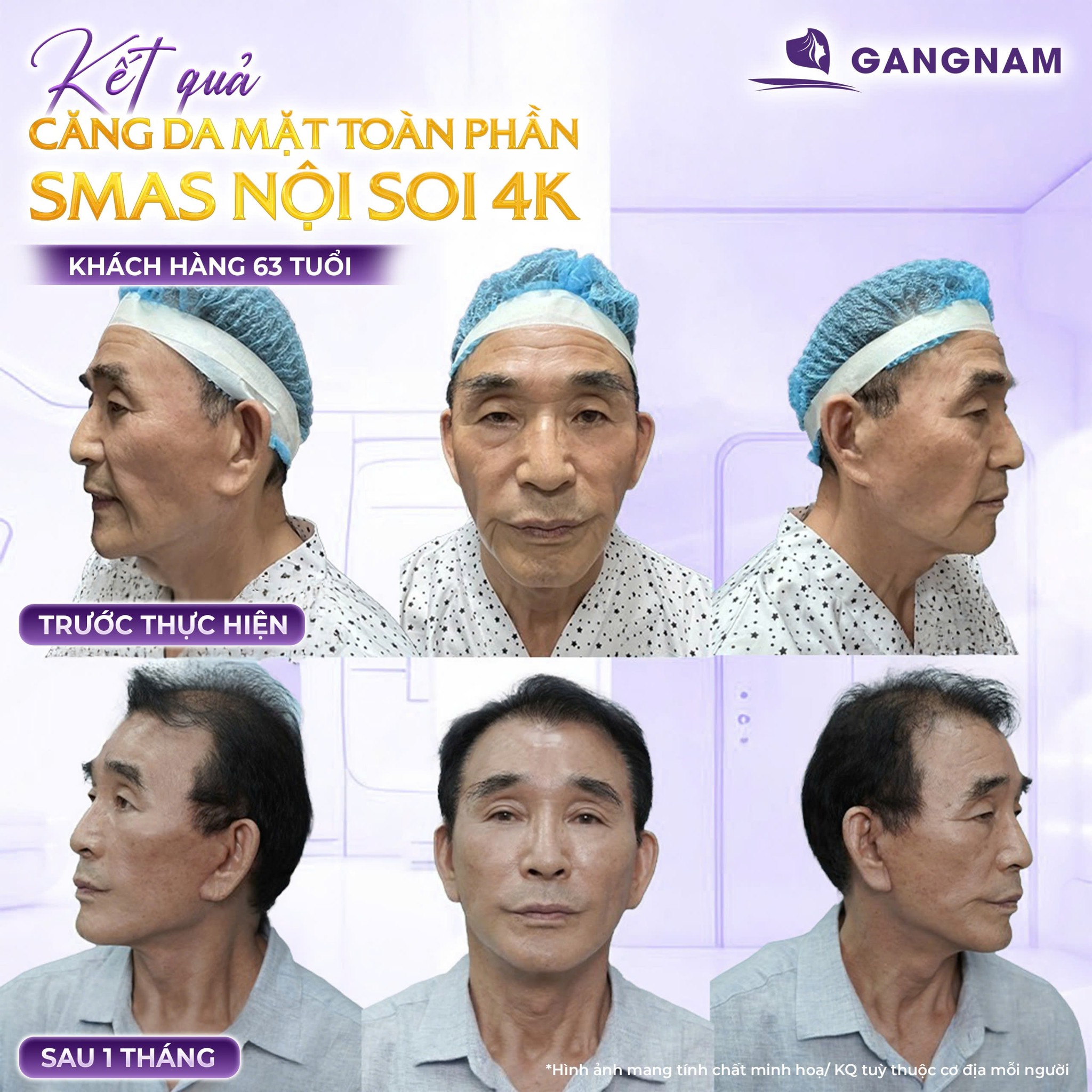 Trẻ Hóa Da Mặt Nội Soi Là Gì? Ưu Điểm, Quy Trình Và Hiệu Quả Thực Tế 4 Trẻ hóa da mặt nội soi là gì?