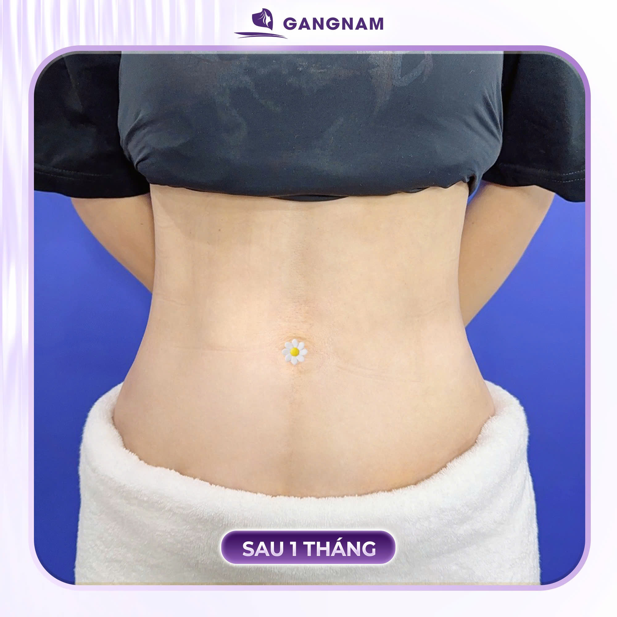 Hút mỡ bụng Lipo nội soi: Giải pháp đột phá cho vòng eo thon gọn và săn chắc 4 Tìm hiểu công nghệ hút mỡ bụng Lipo nội soi là gì?