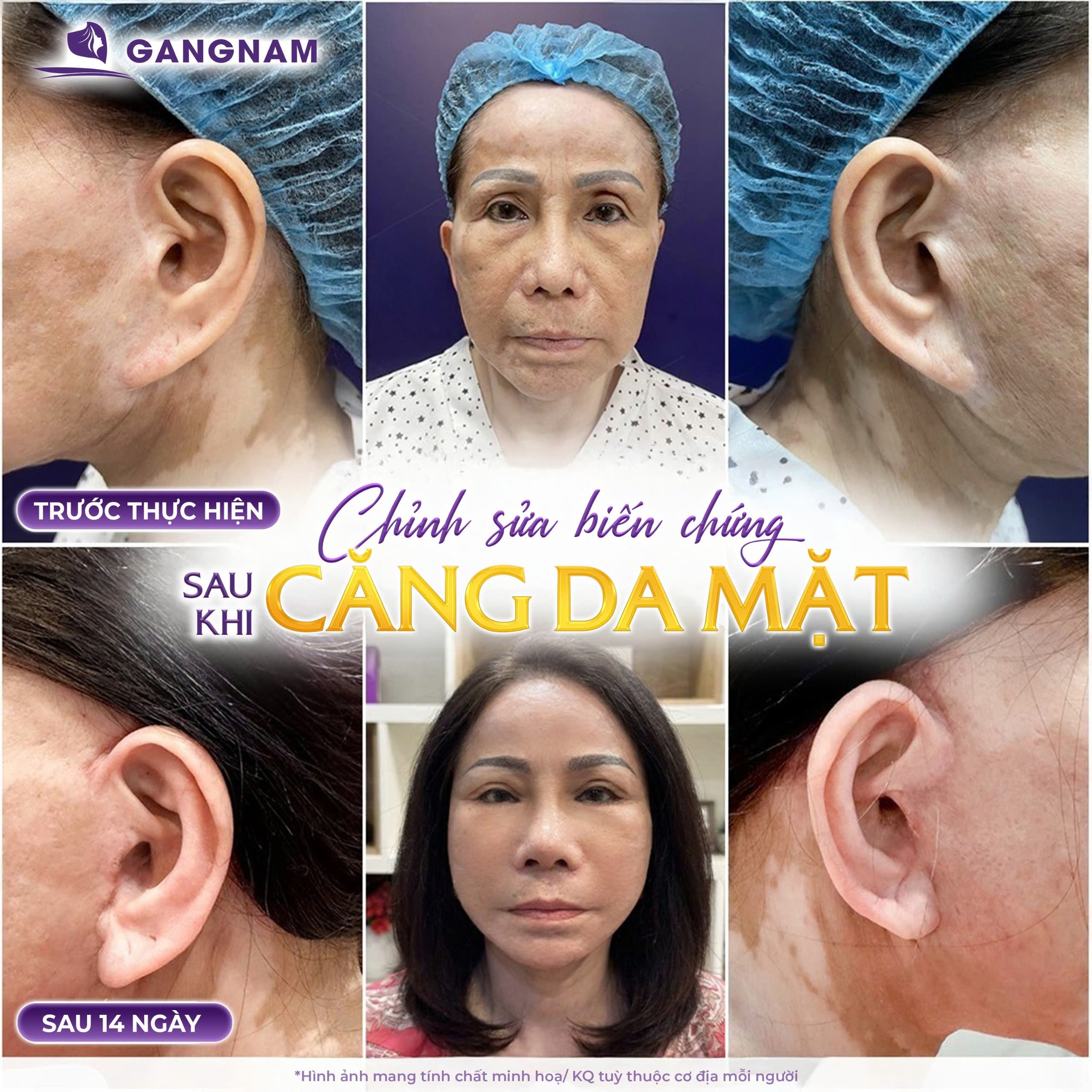 Trẻ Hóa Da Mặt Nội Soi Là Gì? Ưu Điểm, Quy Trình Và Hiệu Quả Thực Tế 5 Các vùng can thiệp phổ biến trong trẻ hóa da mặt nội soi