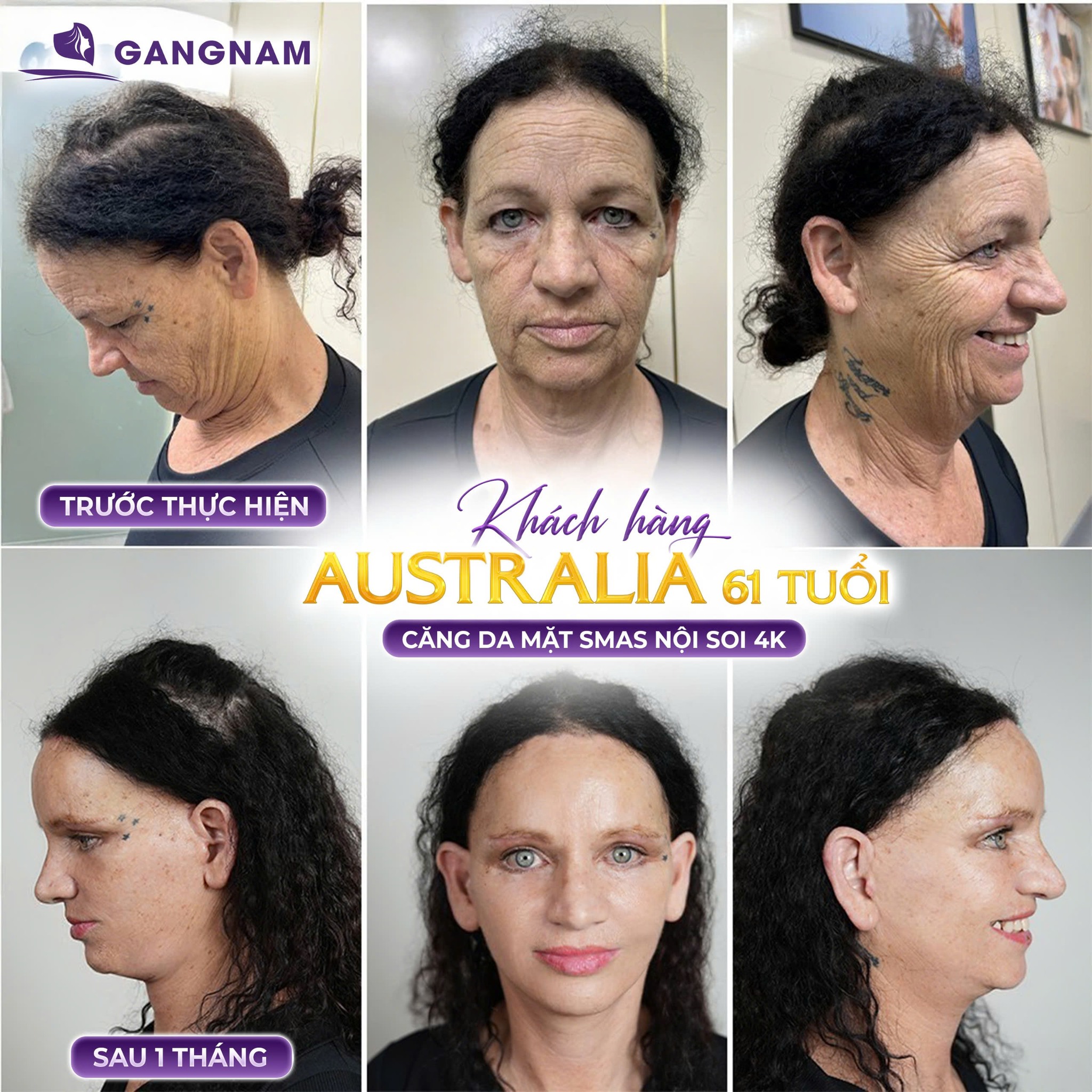 Căng Da Nội Soi SMAS: Bí Quyết Nâng Cơ Trẻ Hóa Tự Nhiên Không Lộ Dấu Vết 4 Căng da nội soi SMAS là gì?