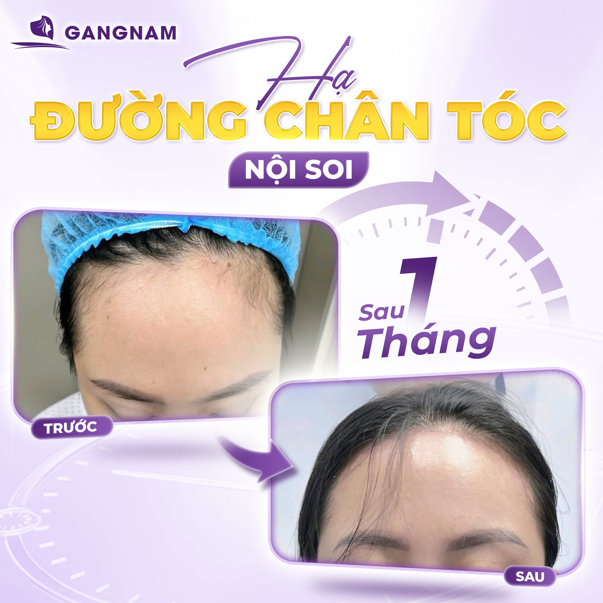 Hạ Đường Chân Tóc Nội Soi: Giải Pháp Thu Gọn Trán Cao An Toàn, Tự Nhiên 4 Hạ đường chân tóc nội soi là gì