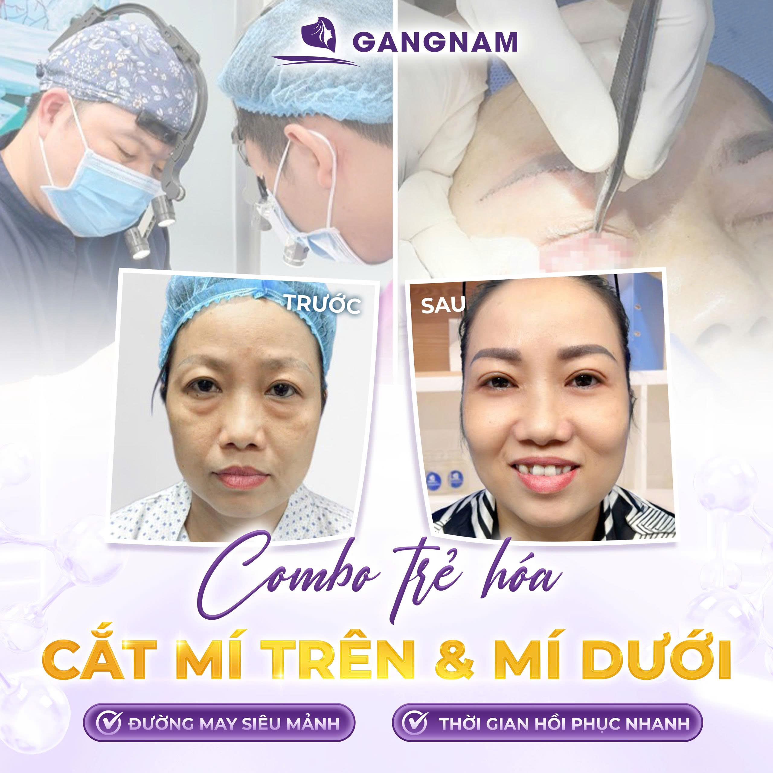 Cắt mí mắt thẩm mỹ: Giải pháp trẻ hóa đôi mắt an toàn, hiệu quả 6 Cắt mí mắt thẩm mỹ tại thẩm mỹ GangNam