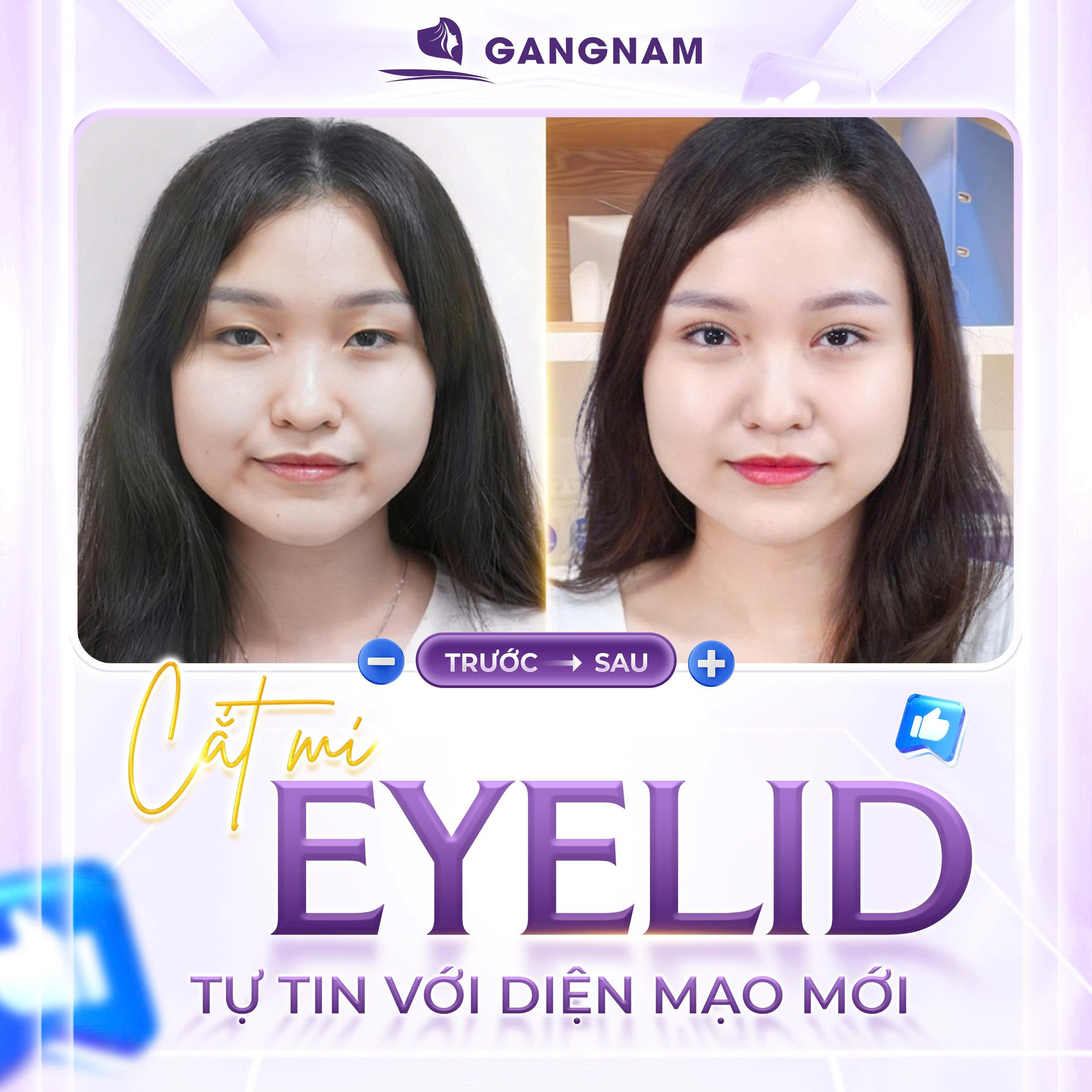 Phẫu thuật cắt mí Eyelid: Giải pháp sở hữu đôi mắt to tròn, trẻ trung tự nhiên 5 Các dáng mí được ưa chuộng sau phẫu thuật cắt mí Eyelid