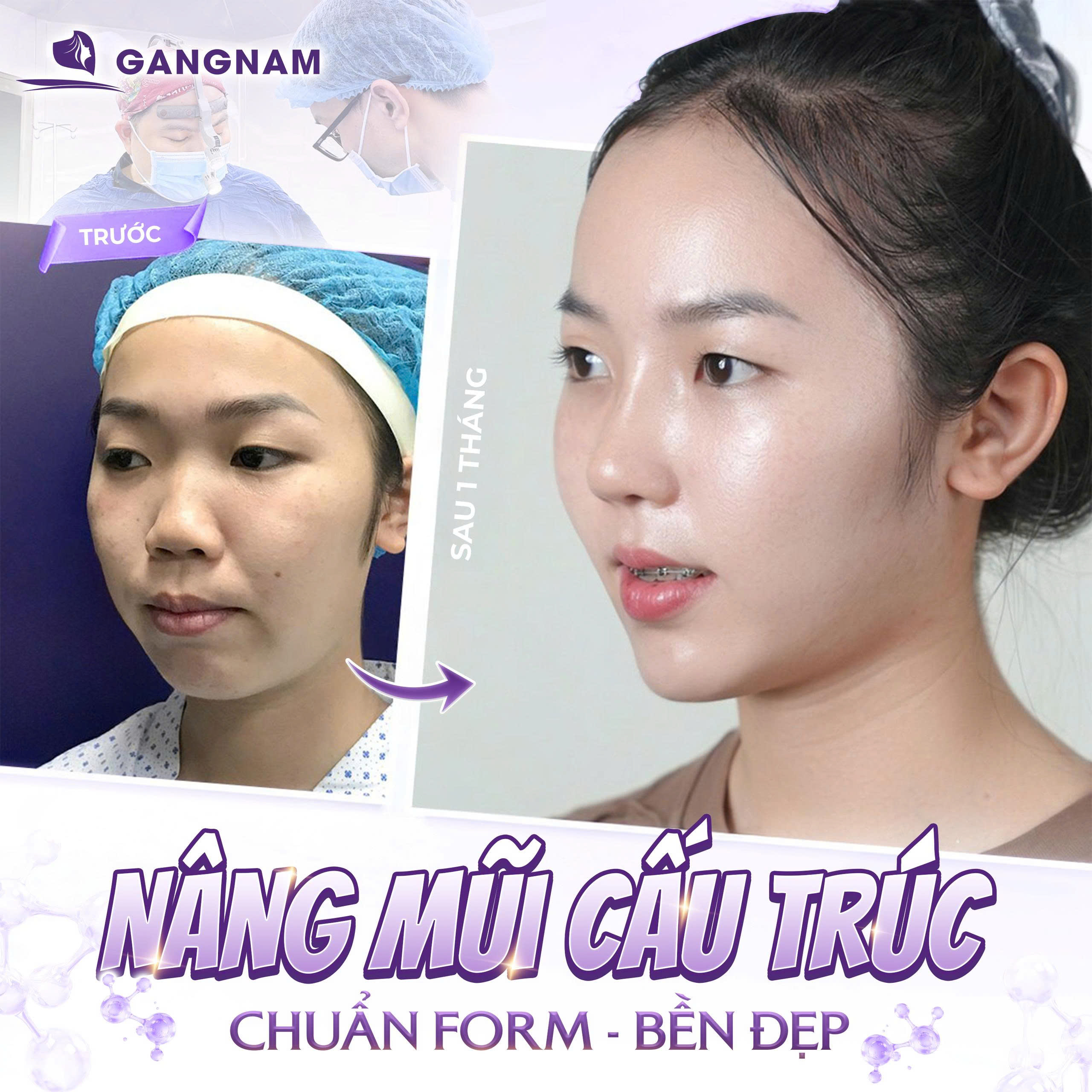 Nâng mũi cấu trúc 3D: Giải pháp tái tạo dáng mũi toàn diện, tự nhiên 6 Nâng mũi cấu trúc 3D tại Thẩm mỹ Gangnam