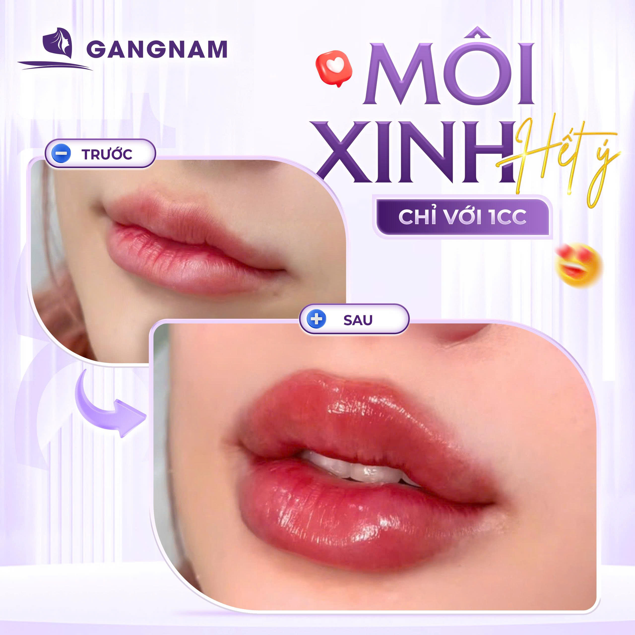 Môi Xinh Nhờ Tiêm Filler: Giải Pháp Tạo Dáng Môi Căng Mọng Tự Nhiên 4 Môi xinh nhờ tiêm Filler là gì?