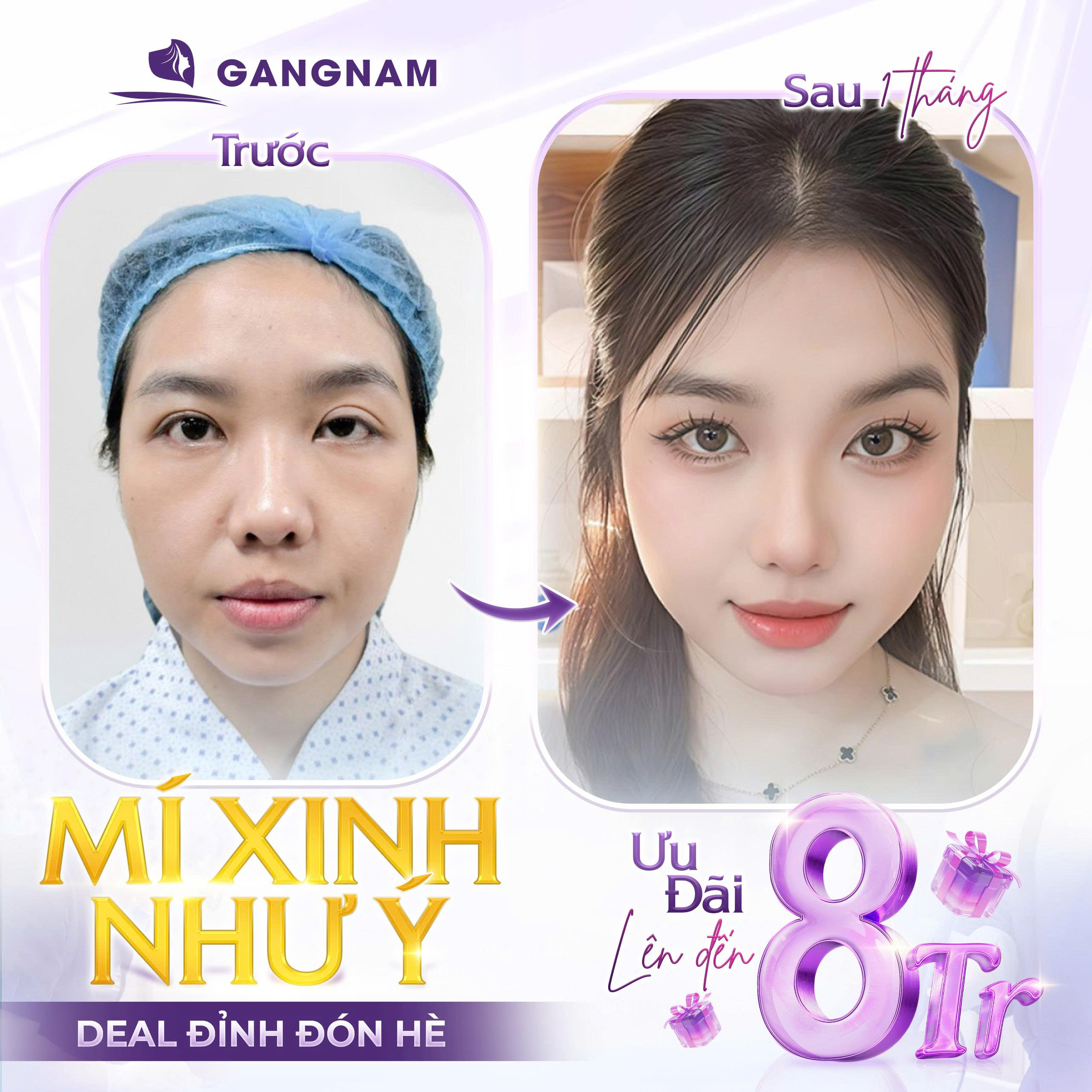 Phẫu thuật cắt mí Eyelid: Giải pháp sở hữu đôi mắt to tròn, trẻ trung tự nhiên 6 Cắt mí Eyelid tại Thẩm mỹ Gangnam