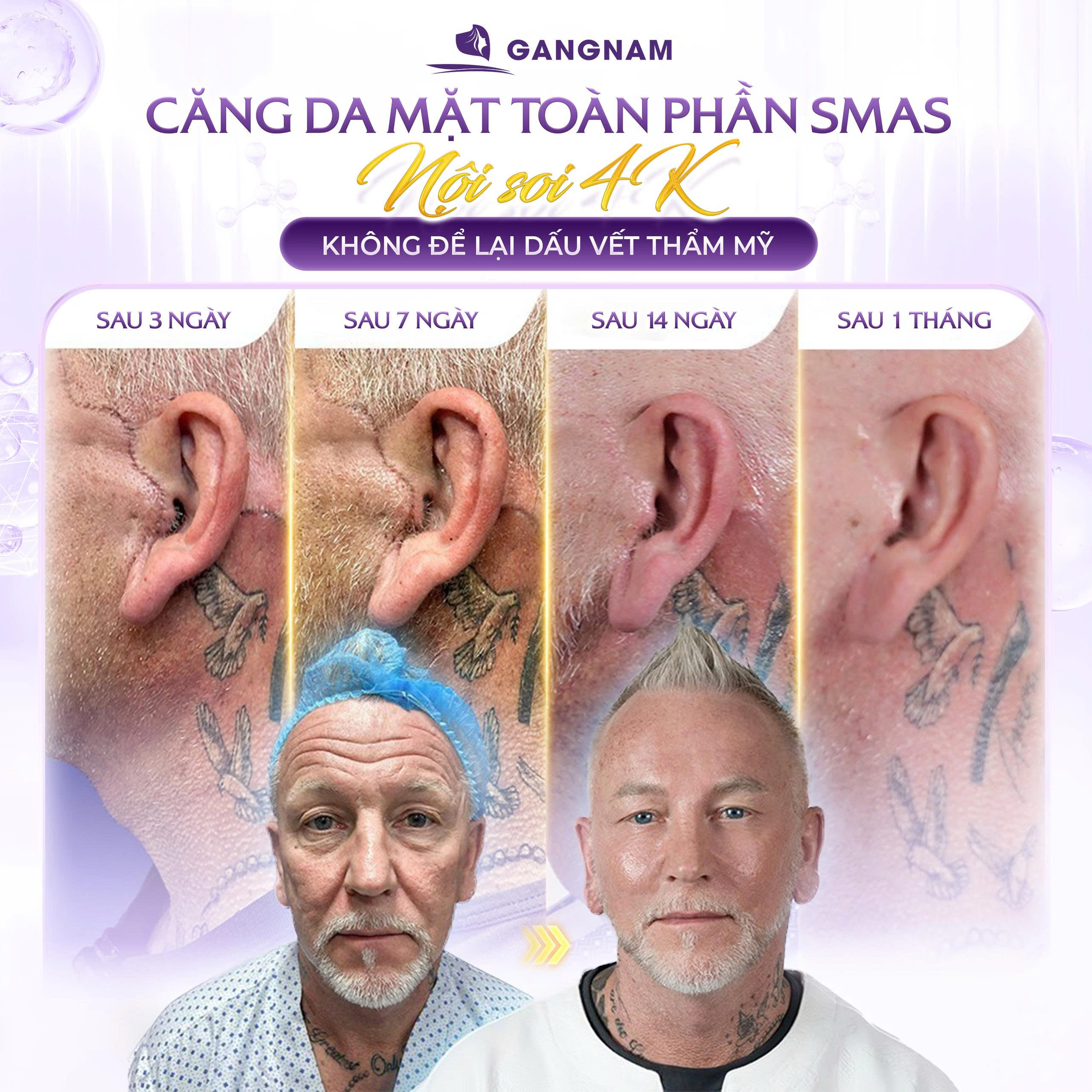 Căng Da Mặt SMAS Trẻ Hóa: Giải Pháp Trẻ Hóa Toàn Diện, Tự Nhiên 6 Căng da mặt SMAS trẻ hóa tại Thẩm mỹ Gangnam