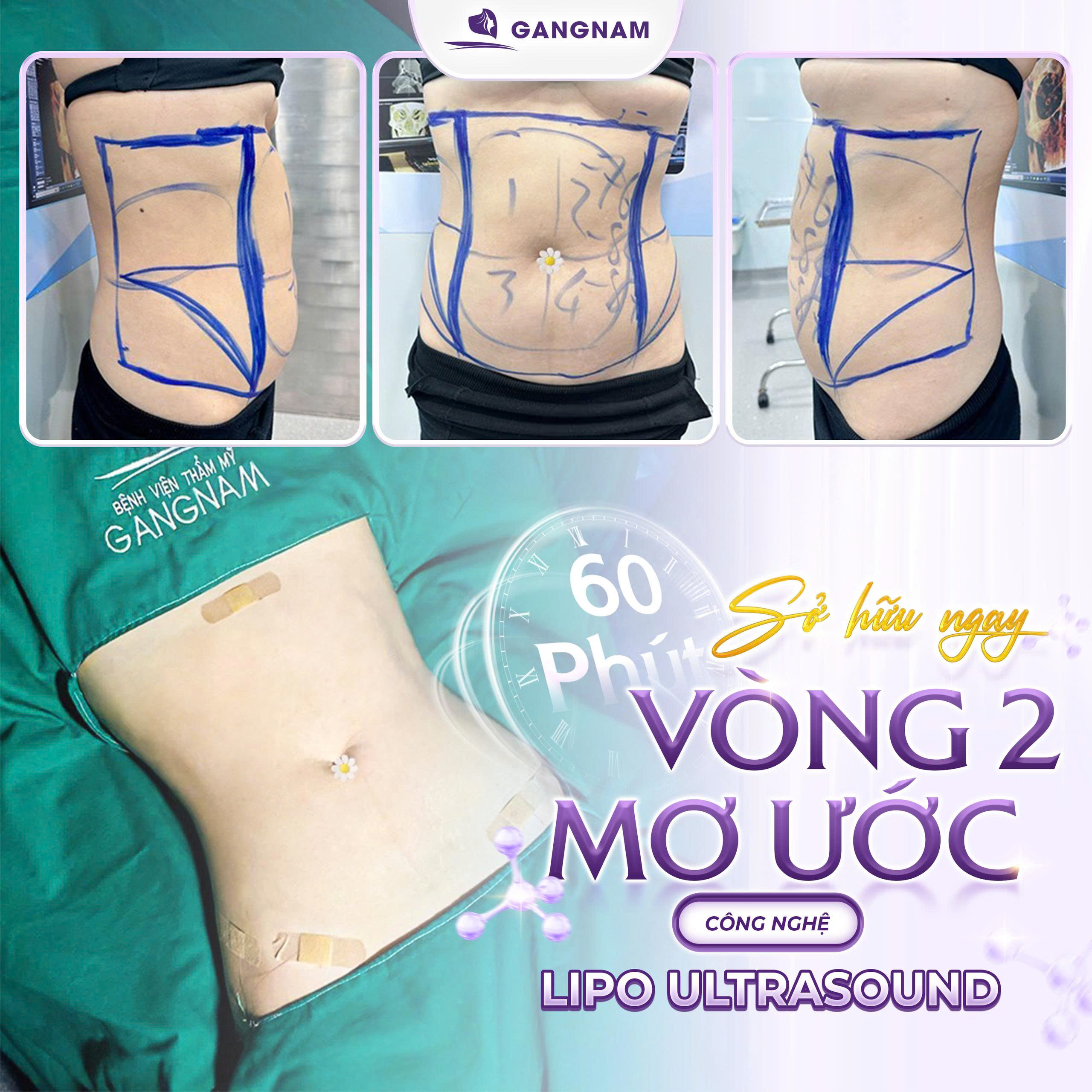 Hút mỡ vòng 2 công nghệ Lipo Ultrasound: Giải pháp giảm mỡ bụng an toàn 4 Hút mỡ vòng 2 công nghệ Lipo Ultrasound là gì