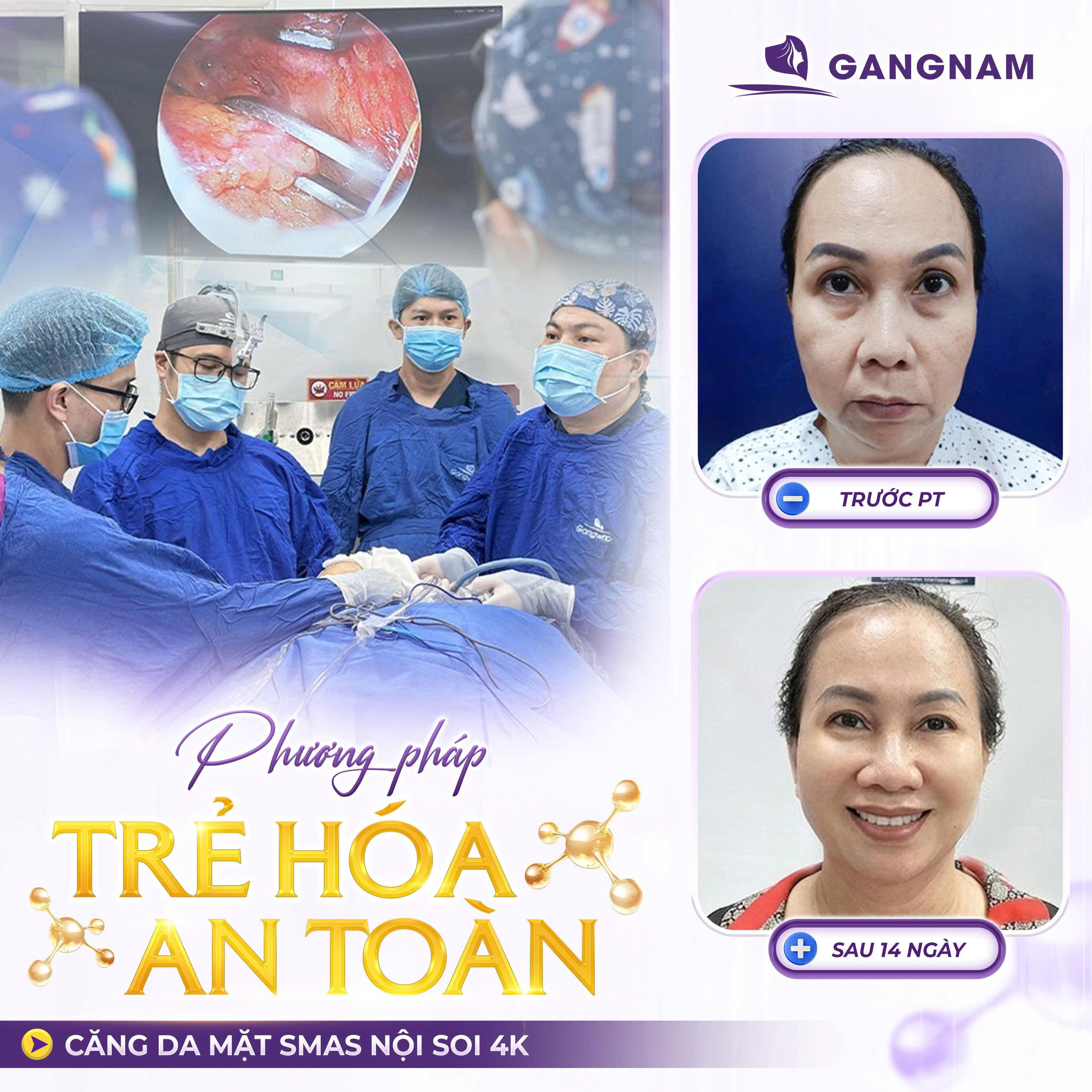 Căng Da Mặt SMAS Trẻ Hóa: Giải Pháp Trẻ Hóa Toàn Diện, Tự Nhiên 4 Căng da mặt Smas trẻ hóa là gì?