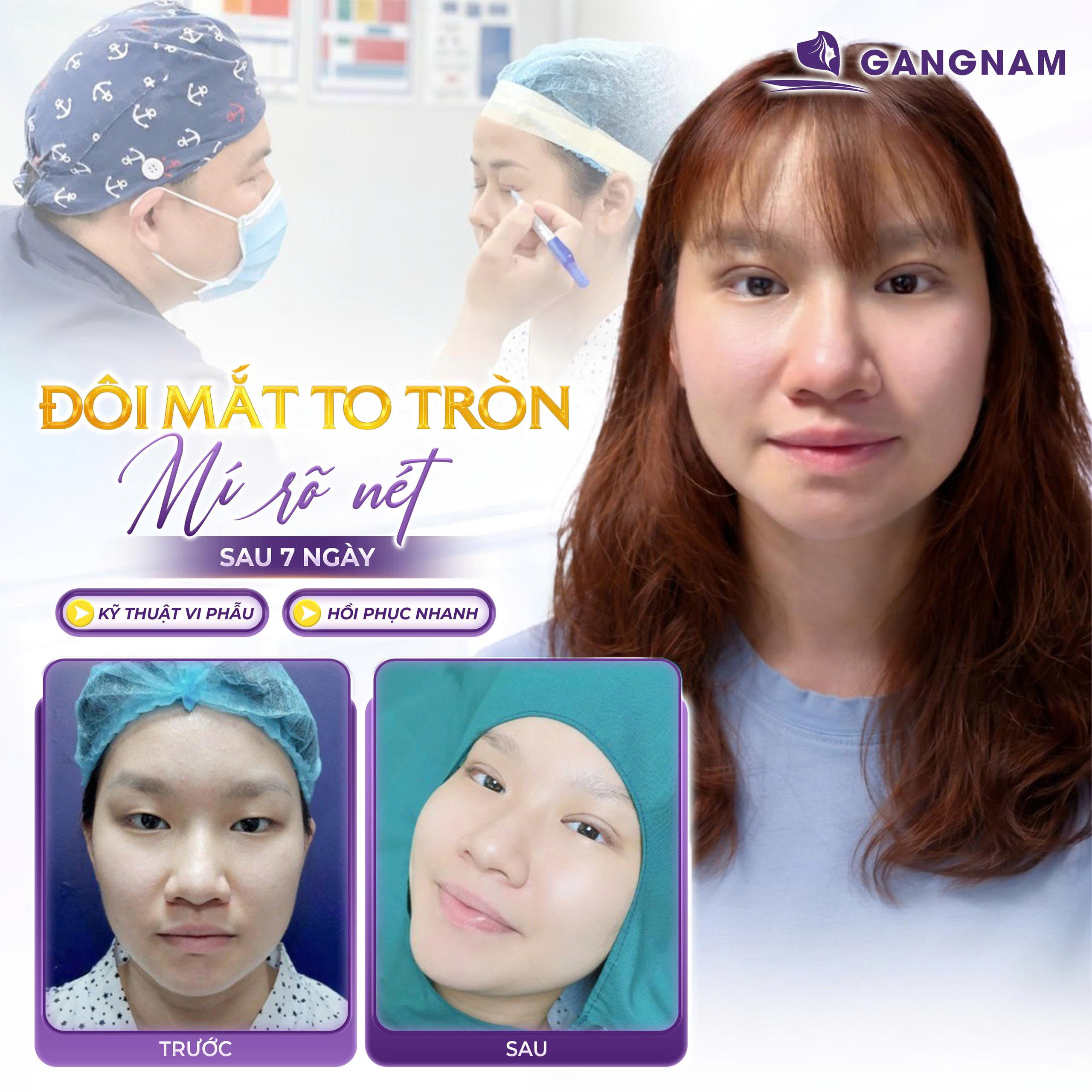 Phẫu thuật cắt mí Eyelid: Giải pháp sở hữu đôi mắt to tròn, trẻ trung tự nhiên 4 Phẫu thuật cắt mí Eyelid là gì