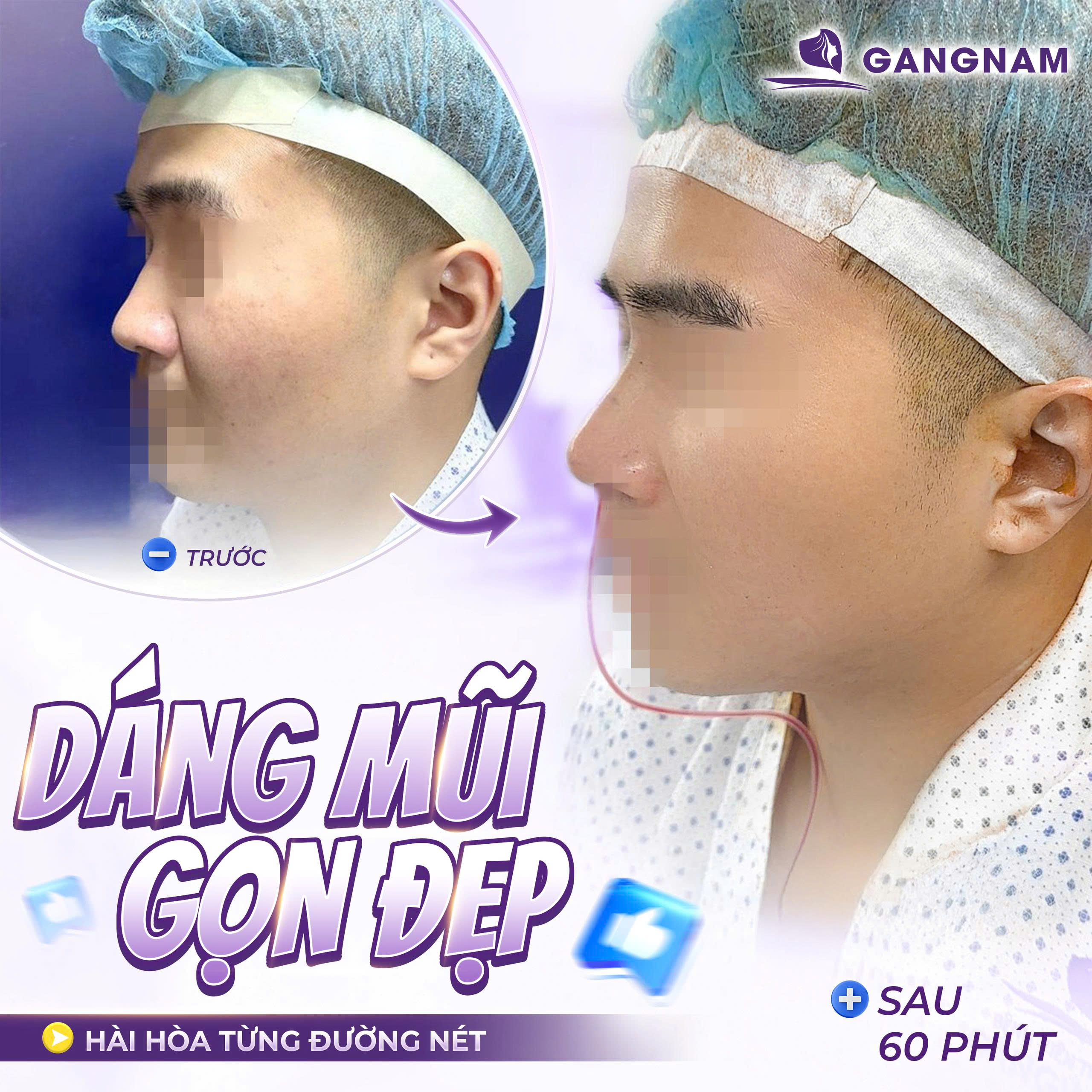 Nâng Mũi Cấu Trúc Nội Soi 3D: Giải Pháp Tái Tạo Dáng Mũi Đẹp Tự Nhiên 6 Nâng mũi cấu trúc nội soi 3D tại Thẩm mỹ Gangnam