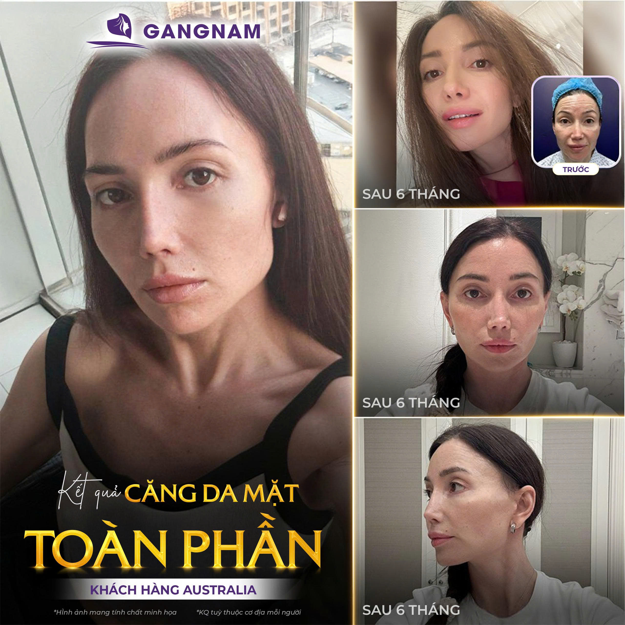 Căng Da Mặt Toàn Phần SMAS: Giải Pháp Trẻ Hóa Toàn Diện 4 Căng da mặt toàn phần SMAS là gì?