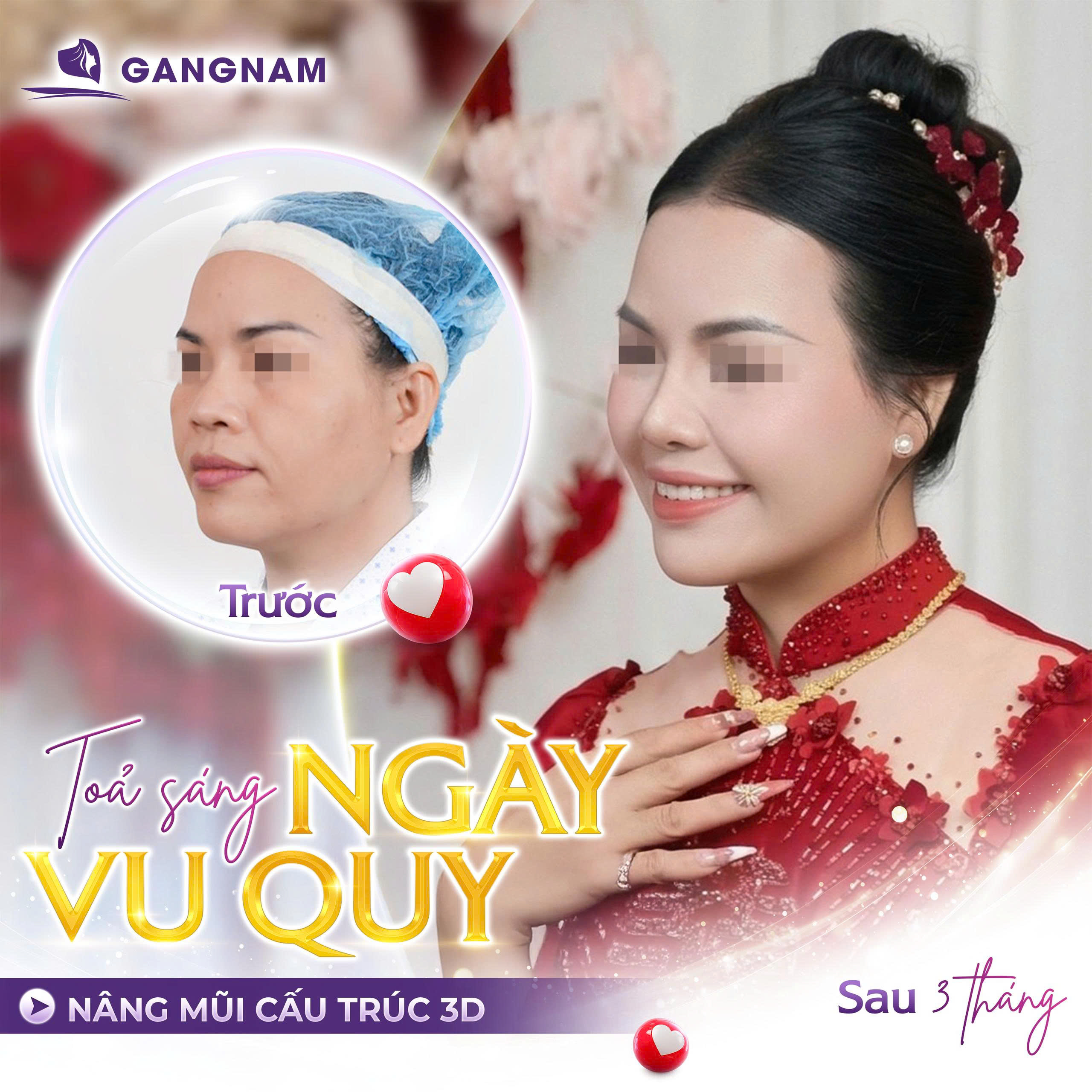 Nâng mũi cấu trúc 3D: Giải pháp tái tạo dáng mũi toàn diện, tự nhiên 4 Nâng mũi cấu trúc 3D là gì?