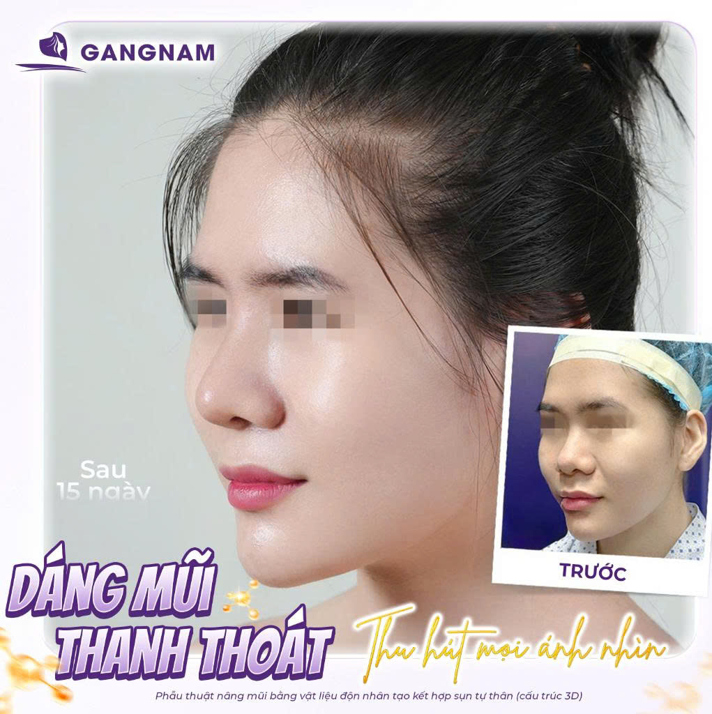 Nâng Mũi Cấu Trúc Nội Soi 3D: Giải Pháp Tái Tạo Dáng Mũi Đẹp Tự Nhiên 4 Nâng mũi cấu trúc nội soi 3D là gì
