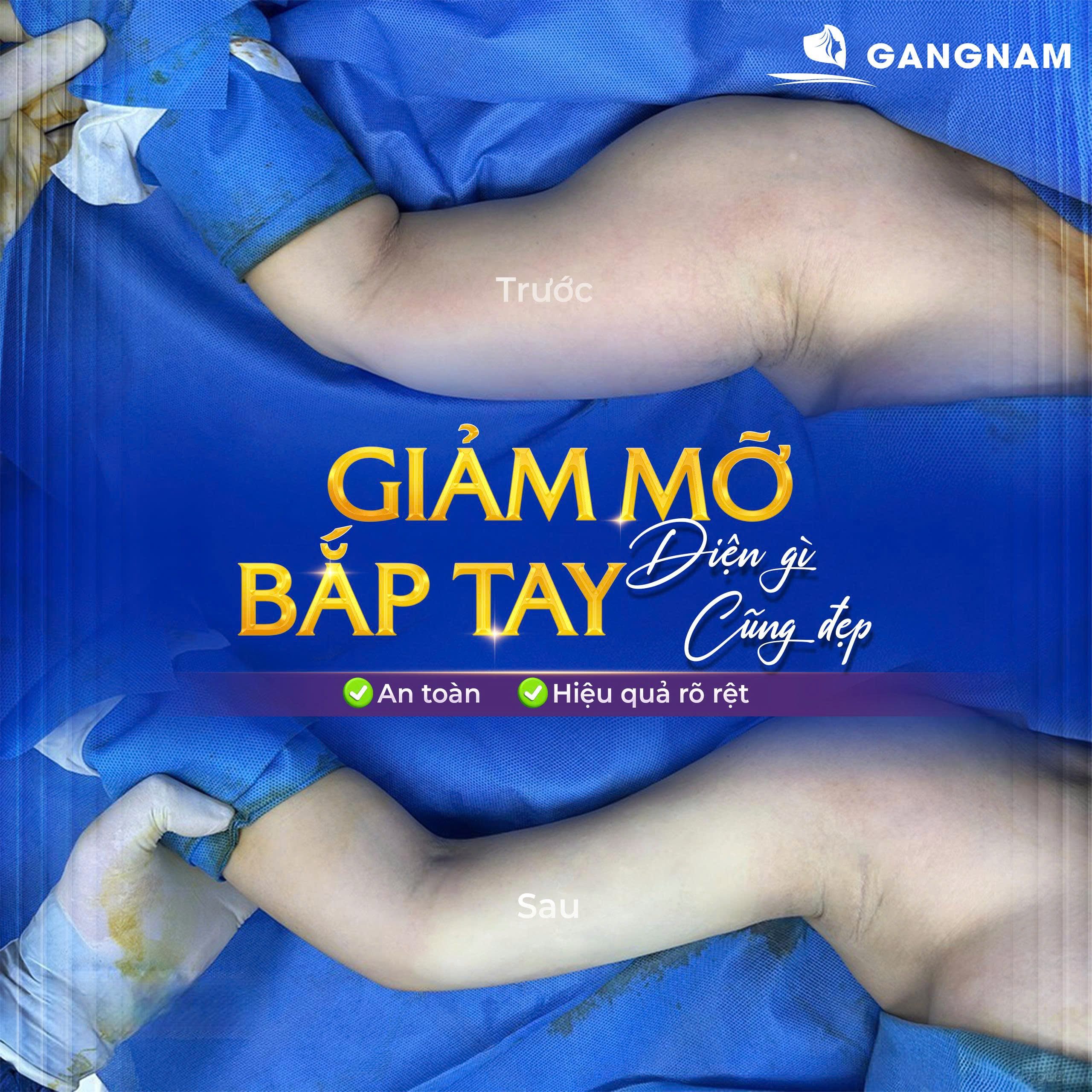 Hút Mỡ Tay Nội Soi: Giải Pháp Giảm Mỡ Bắp Tay Nhanh, An Toàn, Hiệu Quả 4 Hút mỡ tay nội soi là gì và cơ chế hoạt động