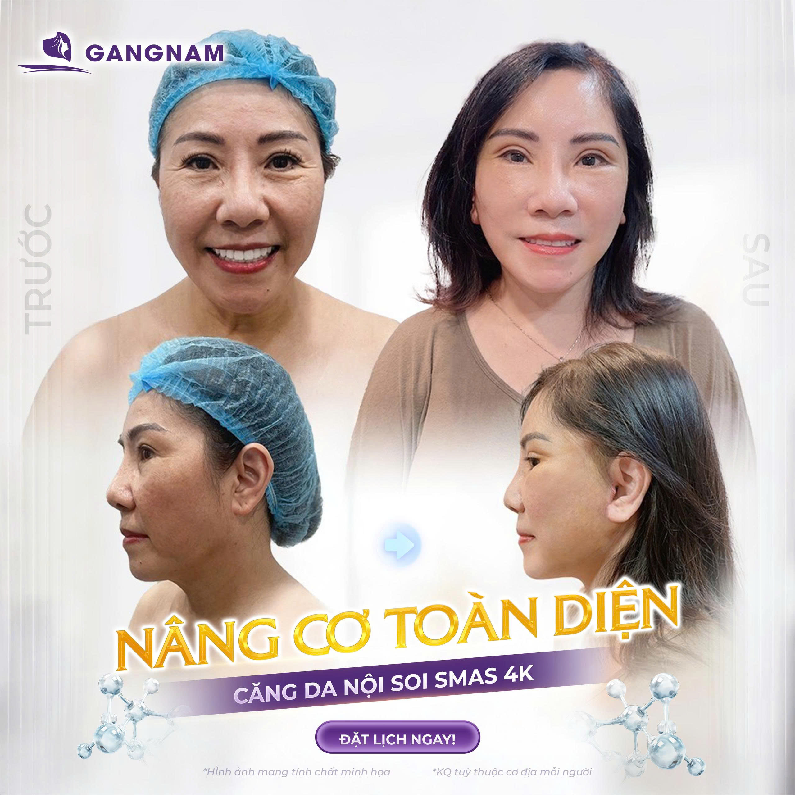 Căng Da Mặt Toàn Phần SMAS: Giải Pháp Trẻ Hóa Toàn Diện 6 Căng da mặt SMAS – Giải pháp trẻ hóa toàn diện tại Thẩm mỹ Gangnam