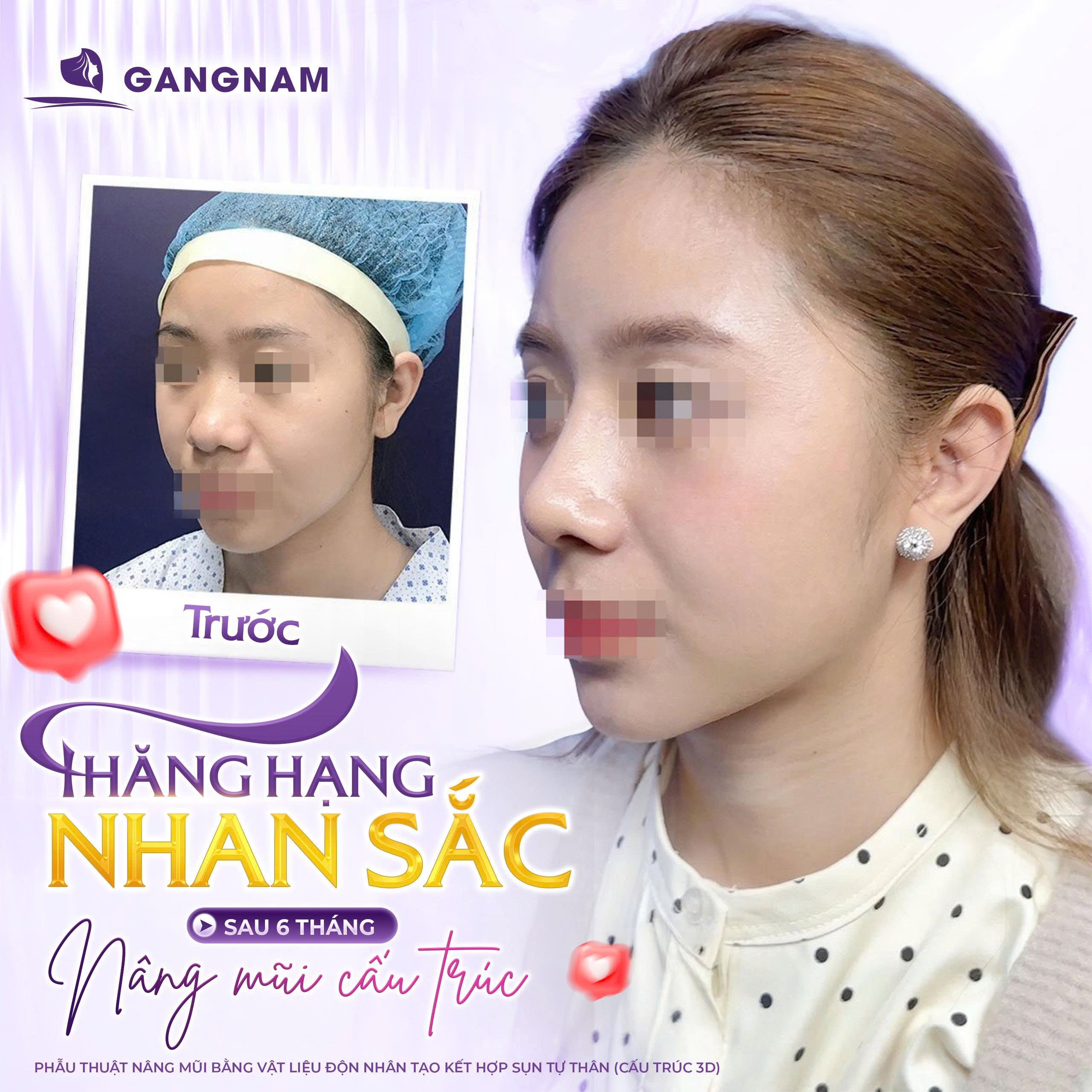 Nâng Mũi Cấu Trúc Nội Soi 3D: Giải Pháp Tái Tạo Dáng Mũi Đẹp Tự Nhiên 5 Gợi ý lựa chọn dáng mũi phù hợp với nâng mũi cấu trúc nội soi 3D