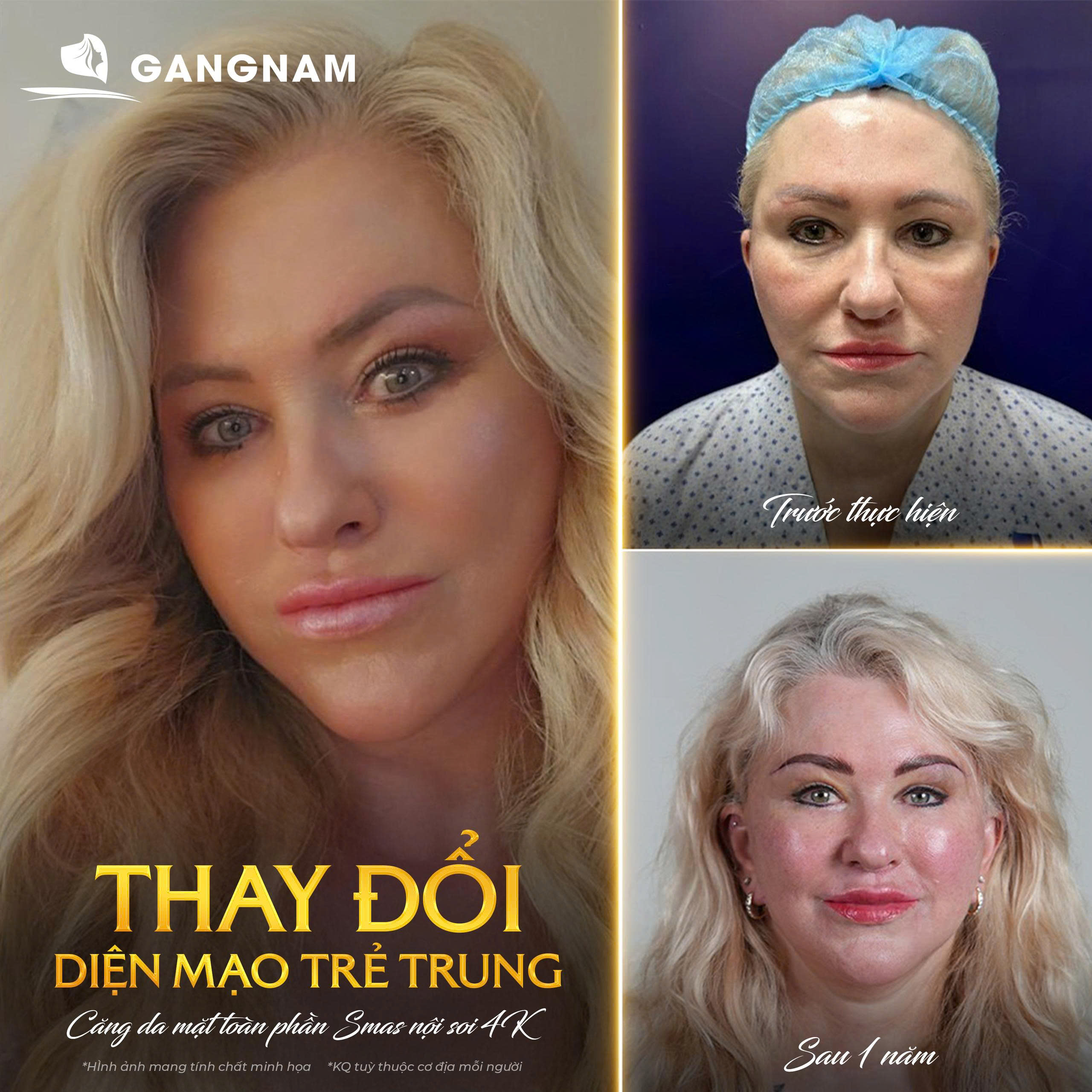 Căng Da Mặt Toàn Phần SMAS Nội Soi – Trẻ Hóa Sâu, Duy Trì Lâu Dài, Tự Nhiên 4 Căng da mặt toàn phần Smas nội soi là gì?